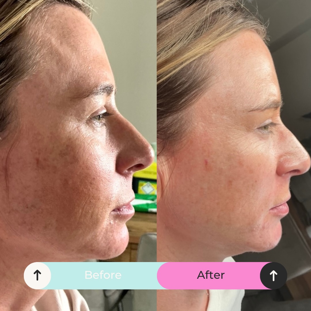 A skin booster Christmas miracle for our lovely client - adding tons of hydration, improving skin texture & quality just in time for the big day 🎅
One session of profhilo creating this gorgeous result - we cant wait to see the result after the second!