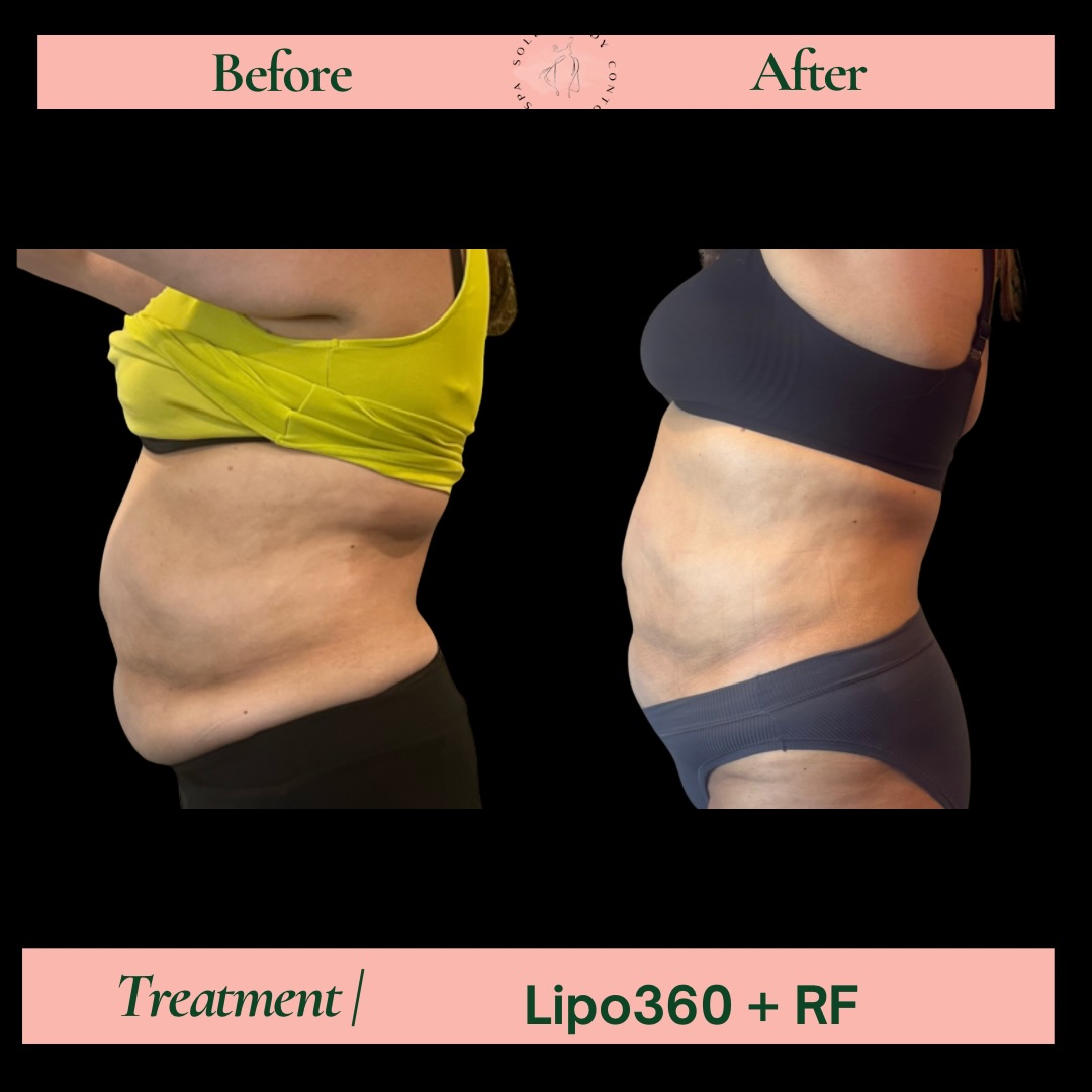 This is your sign to detox before Christmas Eve 🎄✨
Our Lipo360 helps reduce bloating, sculpt your waist, and leave you feeling confident for every holiday event. We have single sessions available!
Limited availability—book your glow now 💚