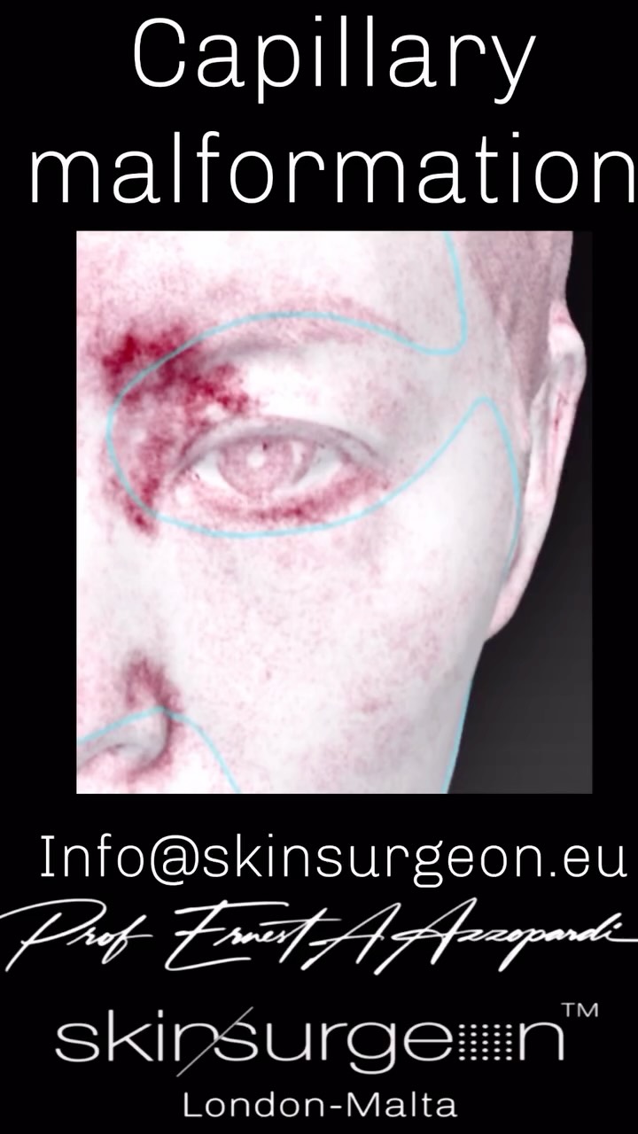 💖Capillary malformations. Precisely treated.
This final post concludes our vascular lesions series.
Periocular and intra palpebral vascular malformations represent some of the most technically demanding laser treatments in medicine. Success depends not on technology alone, but on anatomical insight, laser mastery, and experience.
Treating complex vascular lesions safely — especially in delicate regions — is where expertise and the right kit really and truly matter.
📍 London – Malta
📩 info@skinsurgeon.eu
📧 consultant@skinsurgeon.eu for consultant to consultant referrals
