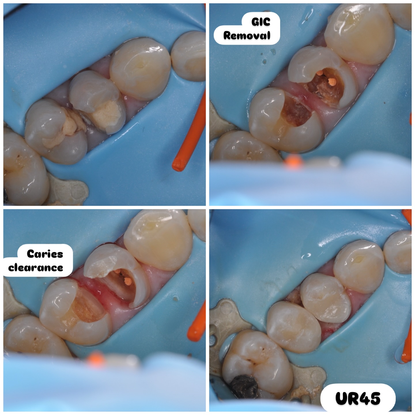 UR45 regular composites #whitefillings #compositefillings #whitetoothfilling #endodontics #cosmeticdentist