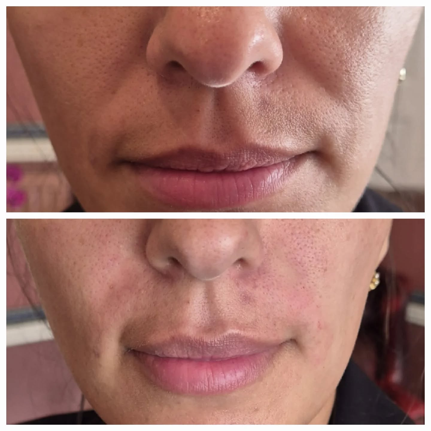 Softening the nasolabial lines to refresh the lower face and restore subtle support, creating a smoother, more youthful appearance while maintaining natural expression.