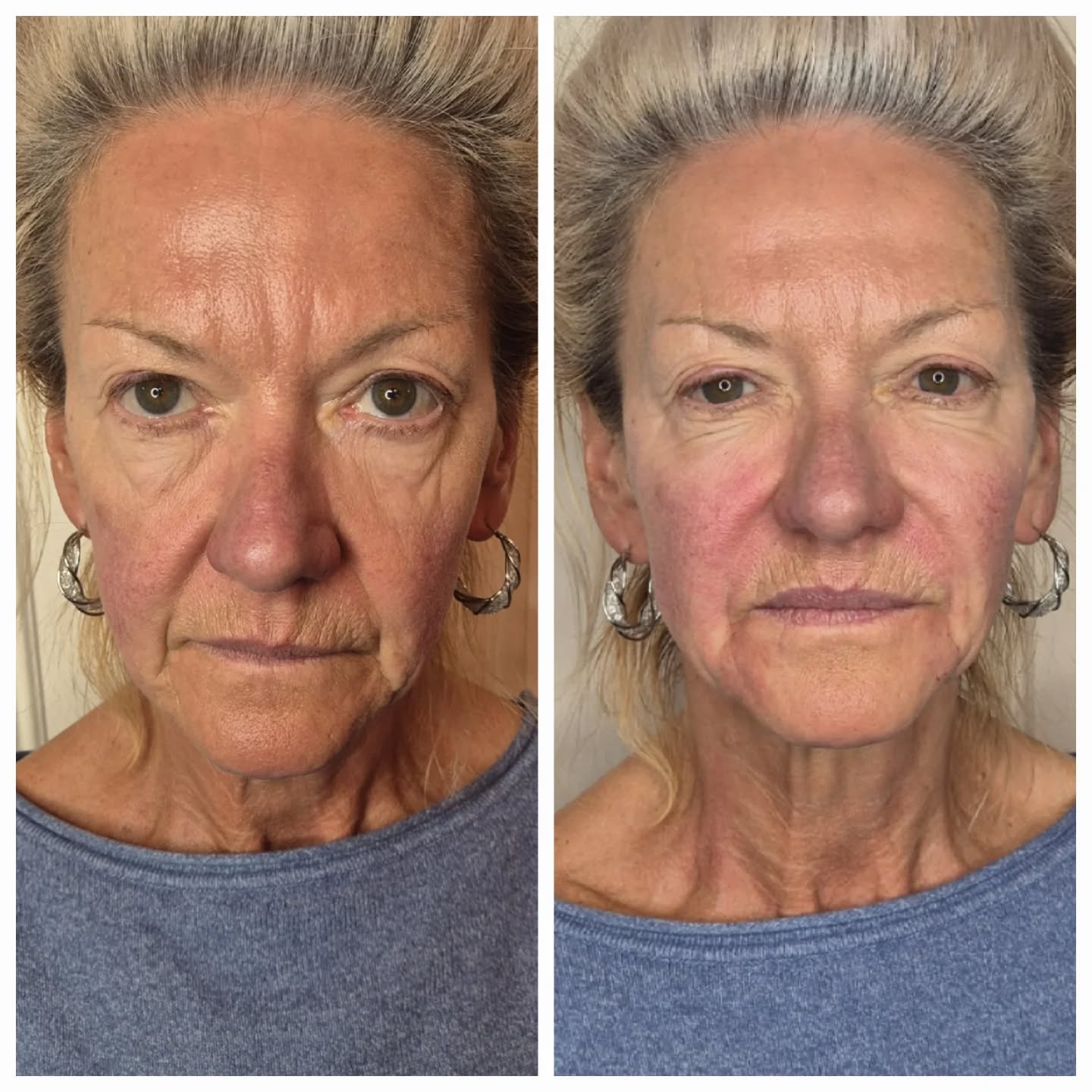 Poly-L-lactic acid (PLLA) treatments such as Sculptra and Aesplla work by stimulating your own collagen production rather than acting as a traditional filler.
What it does?
PLLA is a biostimulator. Once injected, it gradually encourages the skin to produce new collagen over the following weeks and months. This leads to:
🤍Improved skin firmness and elasticity
🤍Subtle lifting of the face
🤍Restoration of volume lost with ageing
🤍Improved skin quality and thickness
Results develop gradually and look very natural, with improvements continuing over time and lasting up to two years or more. It is ideal for patients wanting overall facial rejuvenation rather than instant volume.
