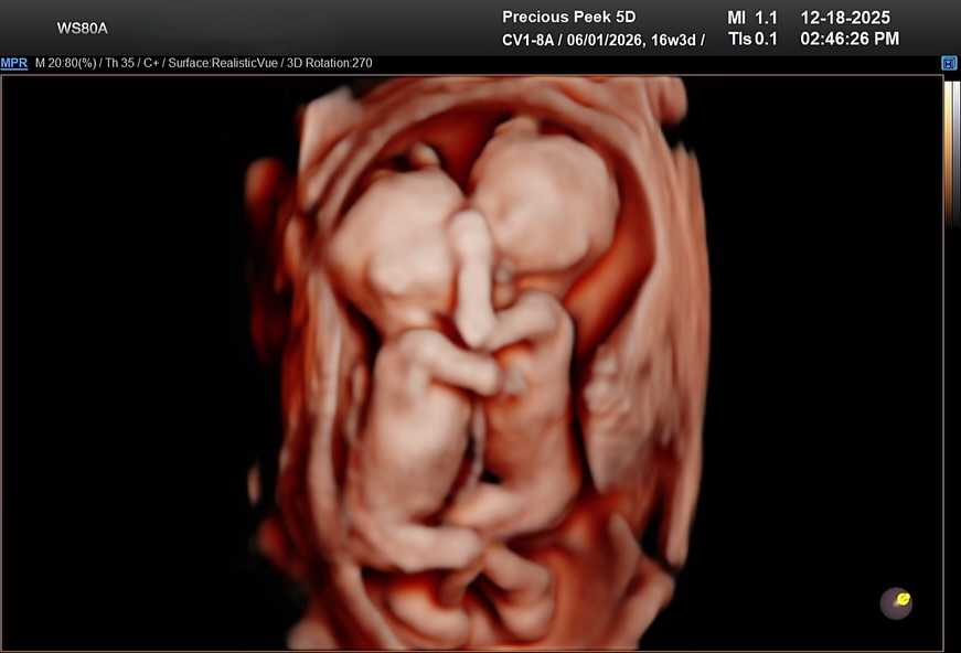 Mono/Di Twins = One Egg, Two Babies 🤍🤍
Monochorionic Diamniotic twins
• One fertilized egg that splits
• One shared placenta (mono)
• Two separate amniotic sacs (di)
• Always the same gender
• Identical!!!
Identical twins run in dads family 🤯
I was able to tell these parents their babies gender today!! Such a special day 😭❤️
#monoditwins #pregnant #ultrasound