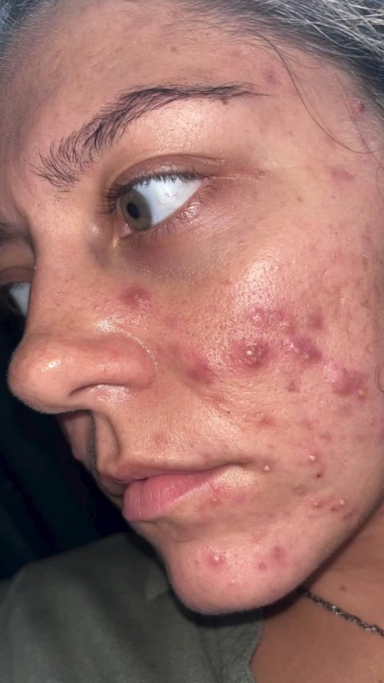 This is Brooke. She’s been on her DMK skincare journey for a couple of months now, and today we’re restocking her home prescriptives.
Brooke struggles with acne, so consistency and the right formulations have been key in keeping her skin clear and balanced.
Her daily routine starts with the Enbioment Cleanser, followed by Beta Gel for healing and inflammation. She then applies CU Klear and her Acu Crème for targeted support. To finish, she locks everything in with the Herbal Mineral Mist.
For nighttime, Brooke also uses Actrol Powder every second evening to help control excess oil, and once a week she does her treatment masque. She alternates her advanced treatments using Revitosin four nights a week, and on the other nights she applies Red Vein underneath Foamy Lift and Exoderma.
And of course, she takes her 4 EFAs each day to support her skin internally.
This combination has been helping Brooke rebuild, rebalance, and keep moving forward in her DMK journey.