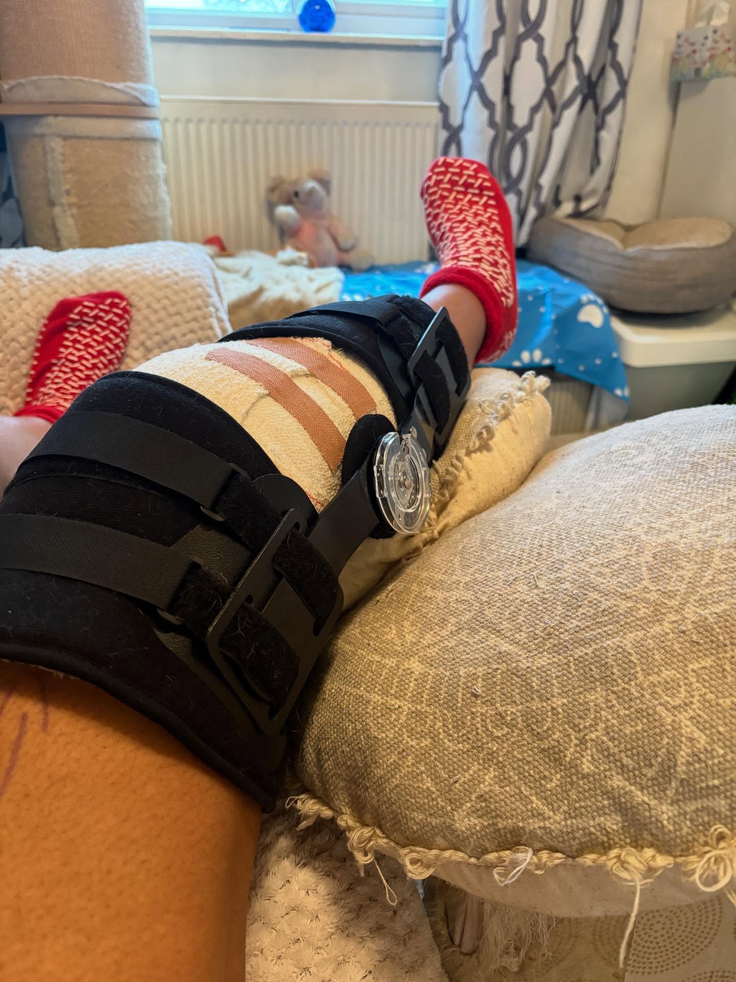 So the journey to my knee healing begins.. my surgery yesterday went well and now I’m on some very strong painkillers and looking forward to having a fully functional knee again! Christmas 🎄 is definitely going to be a relaxing one for me! My original injury first happened in November 2024 and got severely worse ending up in a bucket handle tear due to constant locking of the knee. After the 8th lock the meniscus couldn’t take no more and just ripped off 😖😫 So thankful for the people I have had around me during this time, keeping my spirits high and looking after me while I heal. Looking forward to training up again and becoming stronger in 2026 💪🏽
#surgery #buckettearmeniscus #fitness #healing #recoveryjourney