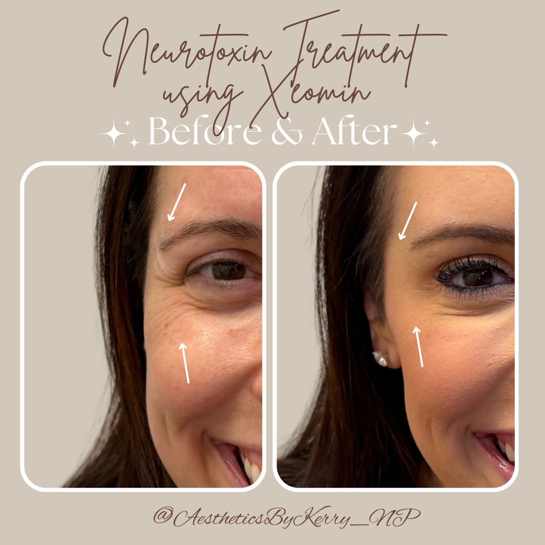 Softening lines, preserving expression—just in time for the holidays 🤍✨💉
.
.
.
#clientspotlight #beforeandafter #xeomin #merzaesthetics #southfloridainjector