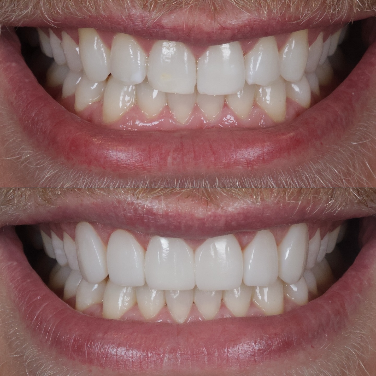 Natural free-hand textured composite veneers on 6 teeth
Designed to enhance the smile while keeping everything natural.
These photos were taken immediately after placement — showing the fine surface textures, contours and details carefully built to mimic natural enamel 🦷
Swipe to see the intricate details up close 👉
DM to start your smile transformation 📩
#compositebonding #compositeveneers #cosmeticdentistry