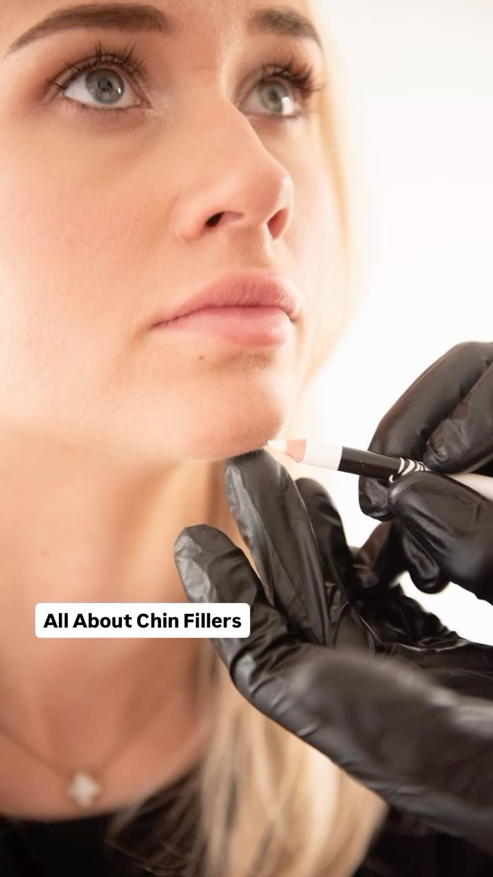 The chin is one of the most underestimated features in the entire face — but it’s also one of the most powerful.
Chin filler isn’t about creating a “pointy” look.
It’s about balance, proportion, and harmony.
When we treat the chin, we look at two key elements:
🔸 Projection — moving the chin forward from the side profile to balance the nose, lips, and jawline.
🔸 Elongation — adding length vertically to create elegance and improve overall facial shape.
Sometimes you need one.
Sometimes you need both.
And often… just 1–2mL is enough to completely transform your profile.
A refined chin can:
✨ Soften or smooth chin creases
✨ Improve facial symmetry
✨ Enhance jawline definition
✨ Bring balance to the whole lower face
✨ Create a more confident, structured profile
Chin filler isn’t just a “small tweak.”
It’s a holistic treatment that elevates the entire face — front and side.
𝖡𝗈𝗈𝗄𝗂𝗇𝗀𝗌
☏ 𝟢𝟩𝟦𝟫𝟪𝟫𝟪𝟩𝟣𝟪𝟪
☞︎ 𝗆𝗂𝖽𝗅𝖺𝗇𝖽𝖼𝗅𝗂𝗇𝗂𝖼𝗌@𝗀𝗆𝖺𝗂𝗅.𝖼𝗈𝗆
✩ 𝗐𝗐𝗐.𝗆𝗂𝖽𝗅𝖺𝗇𝖽𝖼𝗅𝗂𝗇𝗂𝖼.𝖼𝗈.𝗎𝗄
𝖬𝗂𝖽𝗅𝖺𝗇𝖽 𝖠𝖾𝗌𝗍𝗁𝖾𝗍𝗂𝖼𝗌 𝖢𝗅𝗂𝗇𝗂𝖼 𝖢𝗈𝗏𝖾𝗇𝗍ry
✩ 𝖬𝖾𝖽𝗂𝖼𝖺𝗅 𝖯𝗋𝖺𝖼𝗍𝗂𝗍𝗂𝗈𝗇𝖾𝗋 𝖫𝖾𝖽 𝖠𝖾𝗌𝗍𝗁𝖾𝗍𝗂𝖼𝗌
✩ 𝖥𝗎𝗅𝗅𝗒 𝖨𝗇𝗌𝗎𝗋𝖾𝖽 𝖢𝗈𝗌𝗆𝖾𝗍𝗂𝖼 𝖢𝗅𝗂𝗇𝗂𝖼
✩ 𝖯𝗋𝗂𝗏𝖺𝗍𝖾 𝖺𝗇𝖽 𝖢𝗈𝗇𝖿𝗂𝖽𝖾𝗇𝗍𝗂𝖺𝗅
#ChinFiller #ProfileBalancing #FacialHarmonisation #Aesthetics #DermalFiller #BeforeAndAfter