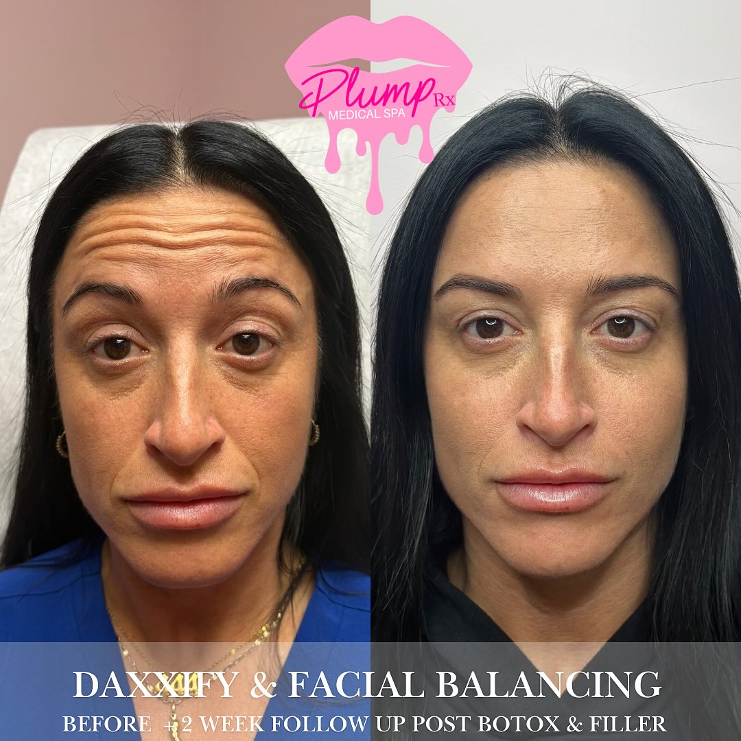 Full-face refresh ✨ Daxxify to smooth the forehead + strategic filler to support the under eyes, cheeks, and smile lines. A rested, refreshed look that still looks completely natural. Saying goodbye to tired eyes and deep lines 🙌🏻
𝐏𝐋𝐔𝐌𝐏 𝐑𝐗 𝐌𝐄𝐃𝐈𝐂𝐀𝐋 𝐒𝐏𝐀
📍 Reading, Ma
𝔽𝕠𝕣 𝔸𝕡𝕡𝕠𝕚𝕟𝕥𝕞𝕖𝕟𝕥:
📲 BOOK NOW: Plumprxmedspa.com
💌𝐏𝐥𝐮𝐦𝐩𝐫𝐱@𝐠𝐦𝐚𝐢𝐥.𝐜𝐨𝐦
📲📞 781-521-0236
#naturalbeauty #FaceSymmetry #nonsurgicalfacelift #beyoutiful #facialcontouring #newyou #bestofthebest #womanowedbusiness
