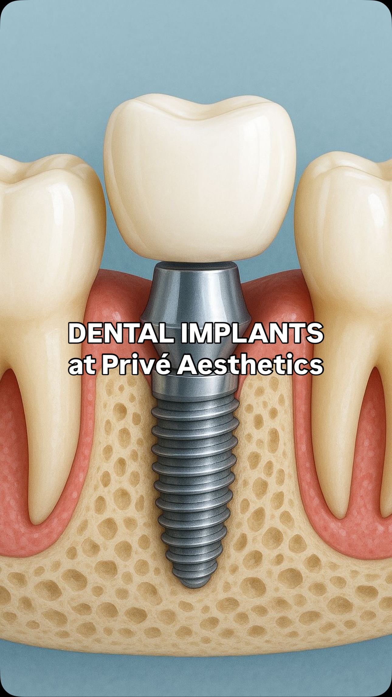 A dental implant is more than replacing a missing tooth — it’s about restoring comfort, confidence, and a natural smile.
With advanced techniques and personalised care, implants look, feel, and function just like natural teeth.
Real client. Real results. Long-term solution.
🦷✨ Book your consultation and smile with confidence again.