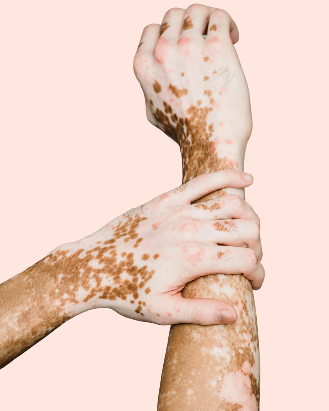 Vitiligo happens when the skin’s pigment-producing cells (melanocytes) slow down or stop creating colour - leaving beautiful, unique patterns that are completely your own.
It’s not harmful or contagious - it’s simply your immune system expressing itself in a different way. The skin still deserves (and needs!) the same gentle love, hydration, and protection.
Those lighter patches? They tell your story - a living artwork of resilience and individuality.
Your skin isn’t flawed. It’s fascinating. It’s yours.
#PeachfaceSkincare #VitiligoAwareness #UniqueBeauty #LoveTheSkinYoureIn #SkinConfidence #NaturalSkincare #ProAgeing #BarrierCare #InclusiveBeauty #SkinPositivity #CrueltyFreeBeauty #PeachyGlow #SkinKindPlanetKind #EverySkinIsBeautiful