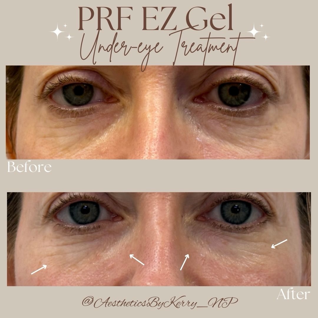 PRF EZ Gel Under-Eye Rejuvenation ✨
A regenerative approach to delicate under-eye rejuvenation.
PRF EZ Gel is created from your own blood and rich in growth factors that support collagen production, skin quality, and soft volume restoration over time.
This treatment is ideal for patients seeking a natural, gradual refresh, and can also be used on its own or in combination with other aesthetic treatments for a beautifully balanced result.
✔️ Supports collagen + tissue health
✔️ Soft, natural-looking improvement
✔️ Designed for the delicate under-eye area
Thoughtful treatments. Elevated results.
📩 Book your personalized consultation today!
#undereyetreatment #growthfactors #antiagingtreatment #nonsurgicaltreatments #southfloridainjector