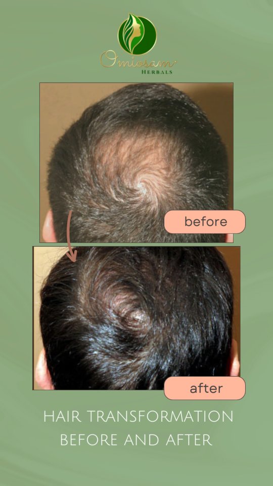 A powerful herbal combination designed to repair damaged hair, boost growth, and restore natural shine—naturally and safely.
Shop Now
www.omiosam.com
+91 9723653569