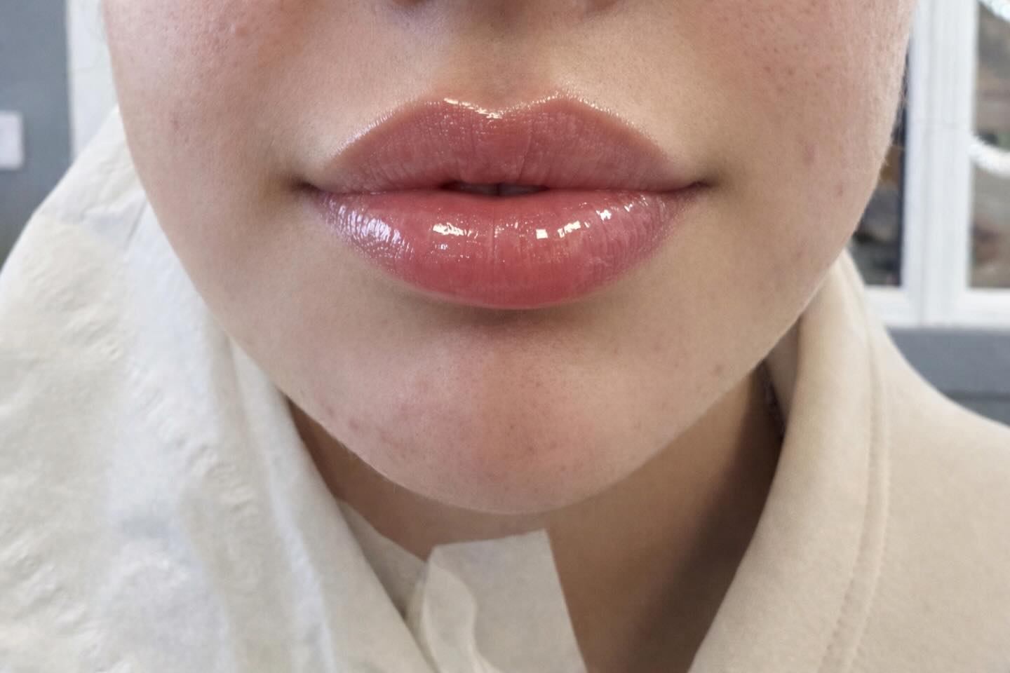 Look at these lips! I did a dental block training yesterday and I did these lips after. This is my best one yet! ❤️ #aesthetocsbyam #oxford #oxfordsalon