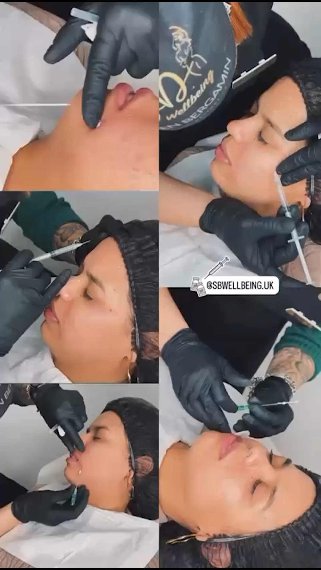 Adeus às linhas que cansam o olhar. ✨
O botox suaviza as linhas de expressão responsáveis por aquela aparência de cansaço e envelhecimento, devolvendo leveza, juventude e harmonia ao rosto.
O resultado?
Um olhar mais descansado, uma expressão mais jovem e natural, sem perder a sua essência.
📲 Agende sua avaliação e descubra o protocolo ideal para você.
+44 7398 192413
.
Goodbye to the lines that make your eyes look tired. ✨
Botox smooths expression lines that cause a tired and aged appearance, restoring lightness, youth, and harmony to the face.
The result?
A more rested look and a younger, natural expression — without losing your essence.
📲 Book your consultation and discover the ideal protocol for you.
+44 7398 192413