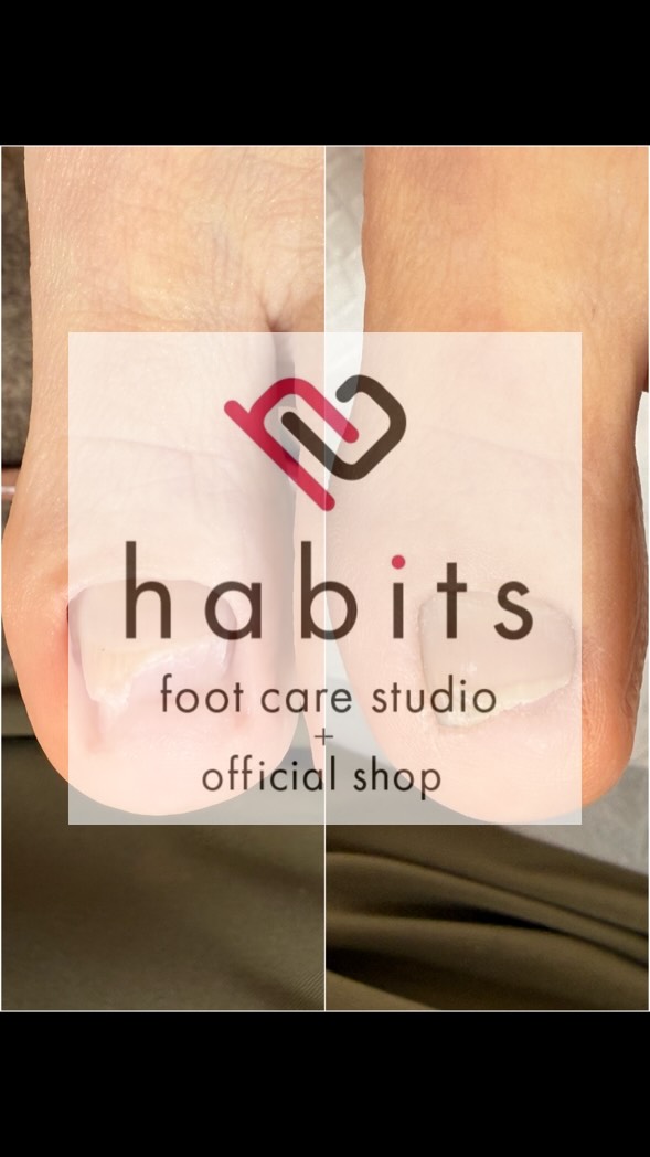 【肥厚爪ケアの経過】
たった2回でも、爪の変化に気づく素敵なケースです。
もっと早く来ればよかったと仰ってくださるお客様。
自分の足じゃないみたい!と喜んでくださるお客様。
笑顔で軽い足取りで帰ってくださるお客様。
ご家族に見せたい!と、帰ってから話題にしてくださるお客様。
その一言と笑顔で、私たちは頑張れます!
だから毎日、『この仕事しててよかった』って思えるんです。
---今まで、独りで悩んで、隠して、ため息ついてた日々に、手を差し伸べたい。---
そんな思いを胸に、フットケアリストをしています。
皆様のこれまでの人