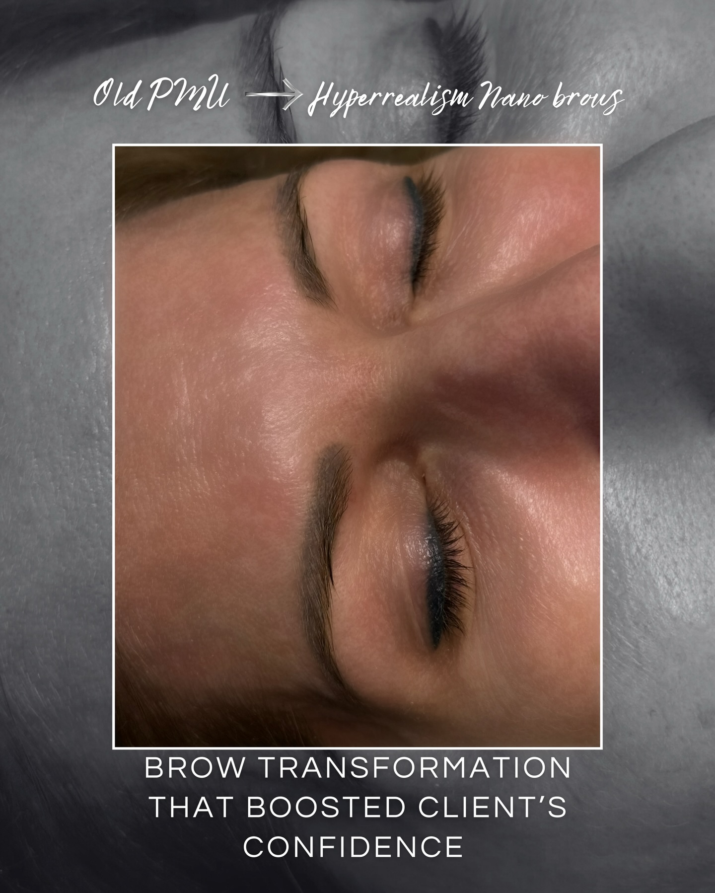 Permanent makeup removal with Canada-approved medical laser and fresh, beautiful nano brows 💫
#oshawatattooremoval #oshawasalon #oshawananobrows #oshawalasertattooremoval #whitbysalon
____________________________________________________
Permanent Makeup Services, Tattoo Removal & Carbon Laser Facial
⬆️Book apt with the link in bio
✨Free Consultation available
📍Oshawa, Ontario
✉️ browsbyieva@gmail.com
📱 +1 416-804-6749
Website: permanentbeautybyieva.com