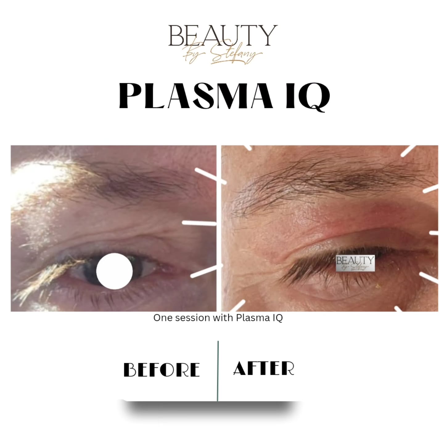 Say goodbye to saggy eyelids with the Plasma IQ Pen! This innovative treatment tightens and lifts the skin around your eyes without surgery. Ready to refresh your appearance? Link in Bio