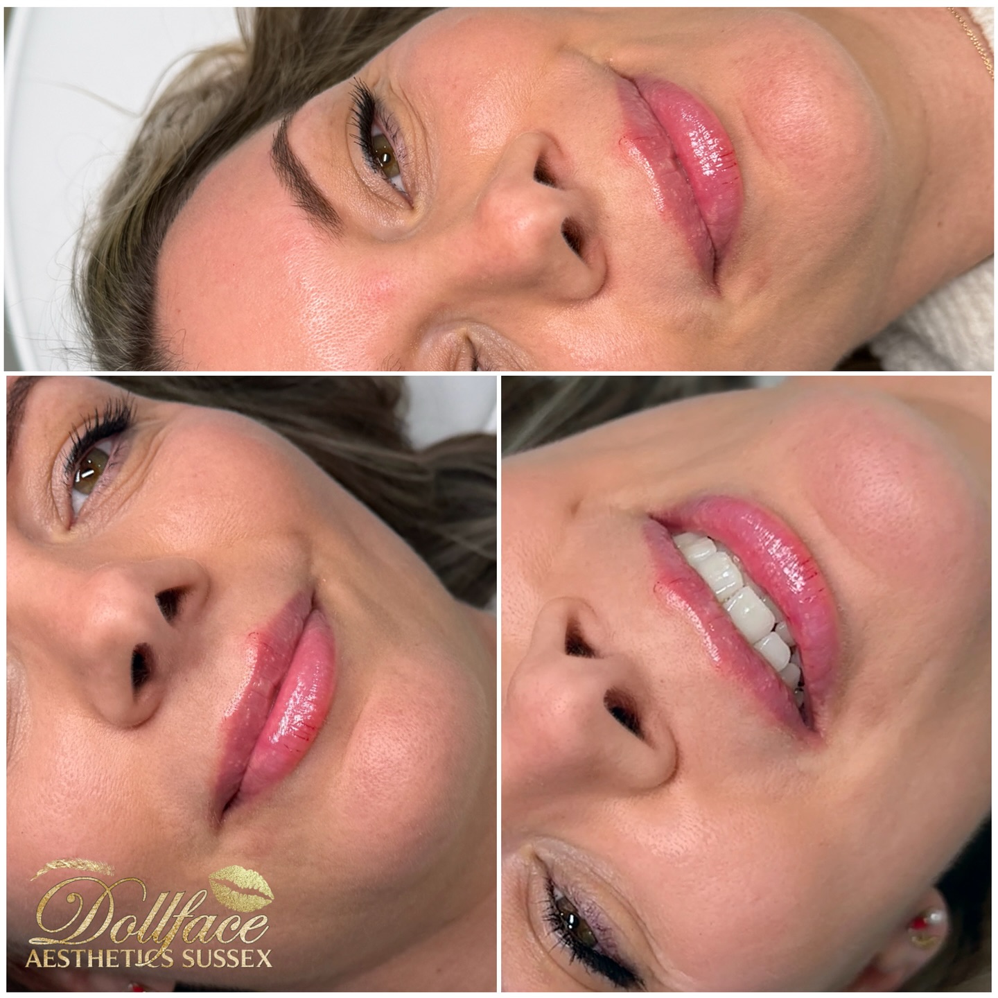 Undetectable tweaks 🧑🍳😘
Did you know your lips lose volume and hydration as you age. Plus the distance between your now and top lip gets longer, this can make you look older.
Lip filler doesn’t have to look overdone in the right hands. Consultation is crucial as we can discuss what your goals are and work towards them (within the boundaries of your natural lip anatomy).
Book your free consultation using the lip on our bio
