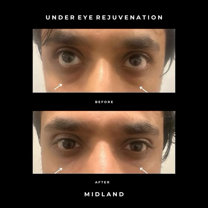 Under-Eye Rejuvenation ✨
“This client came to us saying:
👉 I don’t want dark shadows under my eyes
👉 I don’t like the baggy under-eye area
After trying creams and light makeup, he wanted a long-term solution.
We carefully assessed his under-eye area and treated using just 1mL of Teoxane Redensity 2. By restoring volume in the malar (cheek) area, we were able to:
✔️ Support the under-eye
✔️ Reduce the appearance of shadows
✔️ Mask under-eye fat prolapse
✔️ Create a fresher, well-rested look
✨ Instant improvement
✨ Natural, long-lasting results
✨ Minimal downtime
✨ Treatment completed in under 30 minutes
Subtle changes. Powerful results.
#UnderEyeRejuvenation #TearTroughTreatment #UnderEyeFiller #TeoxaneRedensity2 #AestheticMedicine #NaturalResults #FacialRejuvenation #MaleAesthetics #FreshFace #NoMoreDarkCircles #NonSurgicalTreatment #SubtleEnhancements #MedicalAesthetics #AestheticClinic #ConfidenceBoost