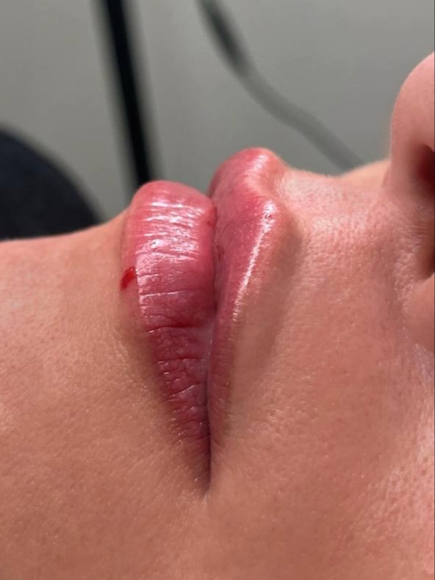 #filler #hyaluron #bamberg #lippen #russianlip