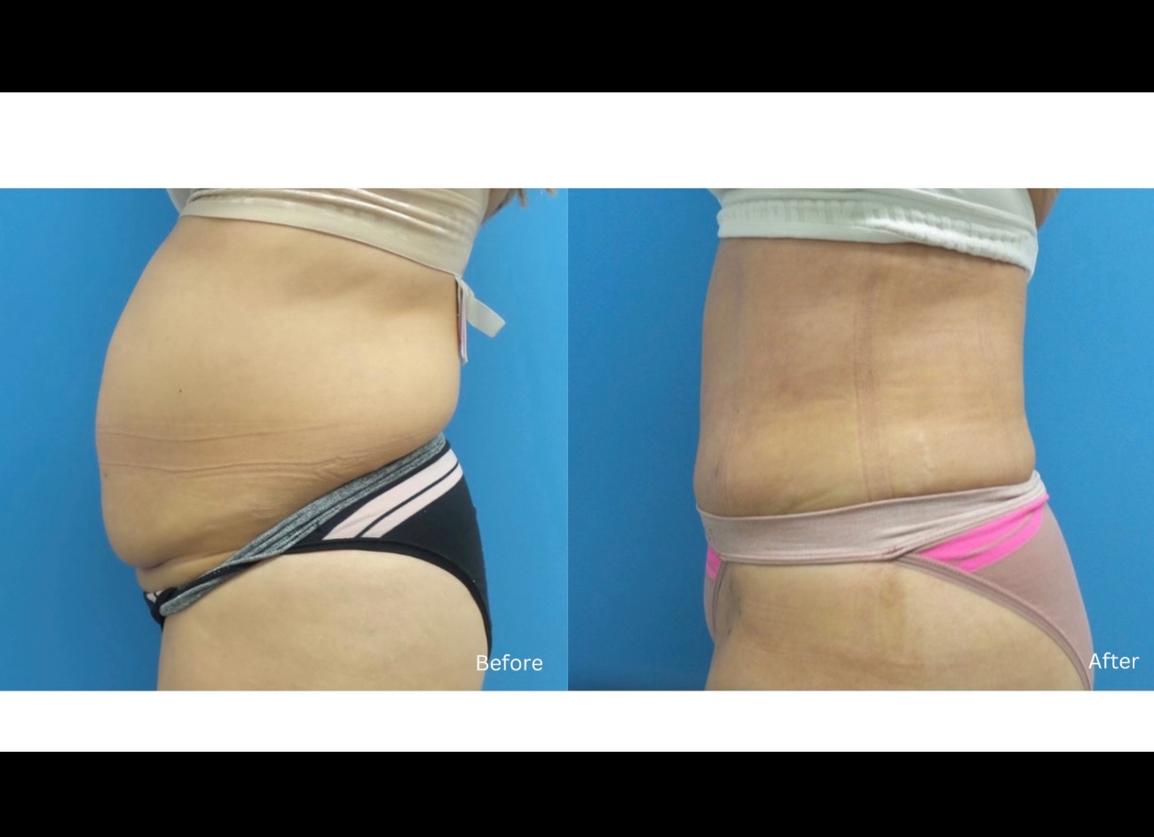 A fresh year deserves a fresh start. 💫
Liposuction can help contour stubborn areas and enhance your natural silhouette because feeling confident in your body sets the tone for everything that follows.
New year. New look. Same you, just more confident.
Performed by Dr. Benjamin Chu. Call today to schedule your consultation! 808-524-1551
.
.
.
#HawaiiPlasticSurgery #BoardCertifiedSurgeon #AestheticEnhancement #NaturalLookingResults #Drbenchu