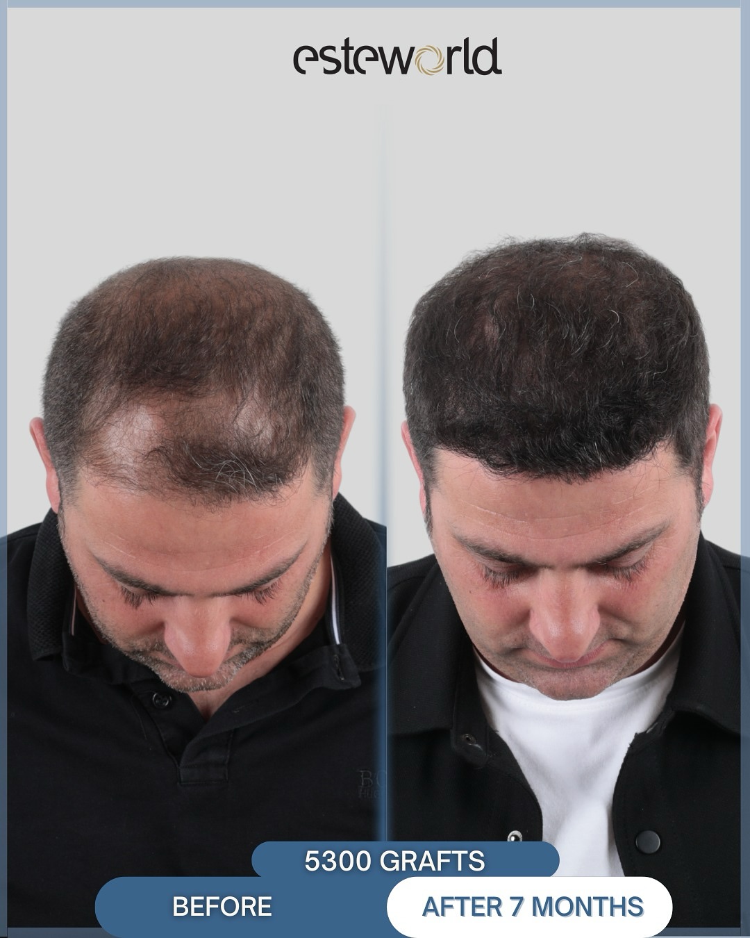 7 hónappal és 5300 grafttal később🤌🏽
A hajhullás sok férfi számára nem csak esztétikai kérdés – hanem az önbizalomról, a magabiztosságról és az önképről szól.
Ez az átalakulás nem csupán új hajat jelent, hanem egy új érzést is:
👉 magabiztosabb fellépést
👉 felszabadultabb mindennapokat
👉 önmagad visszanyerését
A DHI technológia precíz, természetes eredményt biztosít – mert minden férfi megérdemli, hogy újra jól érezze magát a bőrében. 💪
📩 Ha te is gondolkodsz a hajbeültetésen, írj nekünk bizalommal!
#elotteutana #hajbeultetes #DHI #ferfionbizalom #ujkezdet #onbizalom #természeteseredmény #hajhullás #hairtransformation