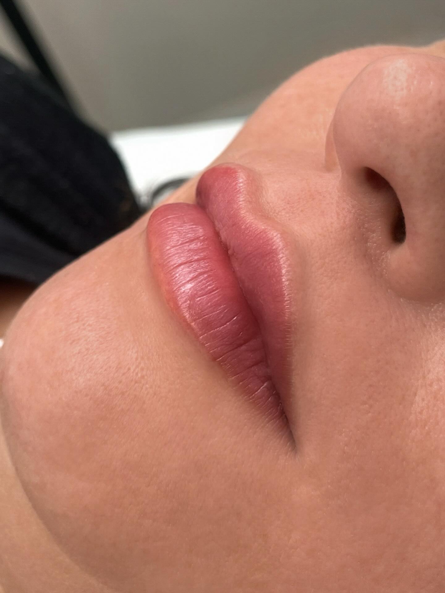 #lippenvergrösserung #hyaluron #bamberg #lippen
💉