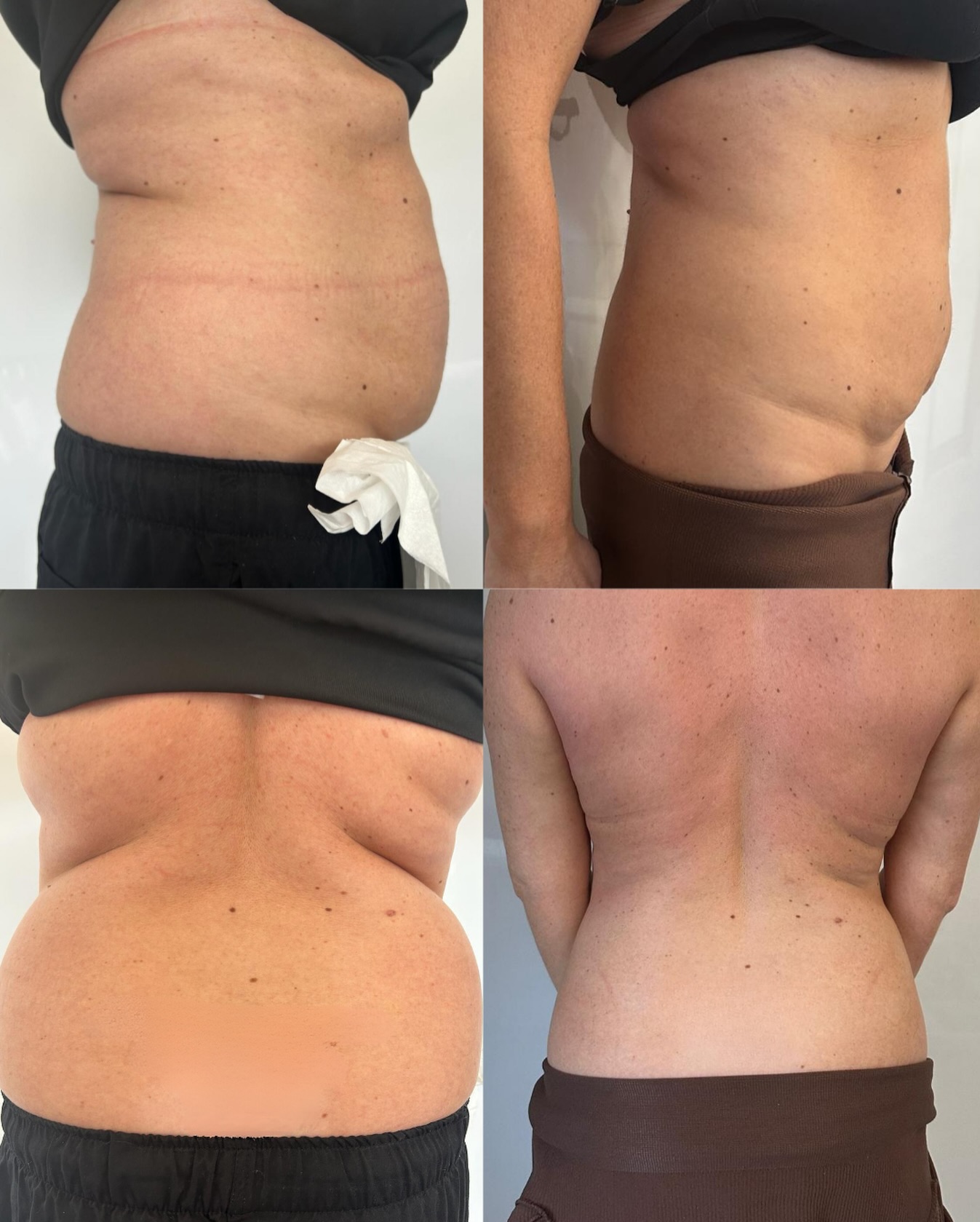 Weight loss kit flash sale 🔥 - just £100
If you’ve over indulged or fell off your weight loss journey wagon, this is the perfect chance to get back to it.
Kits just £100 for the first 20 ordered.
Klarna can be used for payment.
DM ‘Weight Loss’ for more info, or to secure yours.