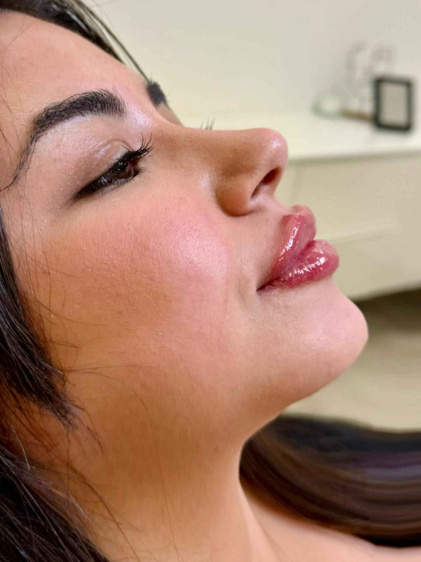 #lips #filler #unterspritzung #schönelippen #bamberg 💉