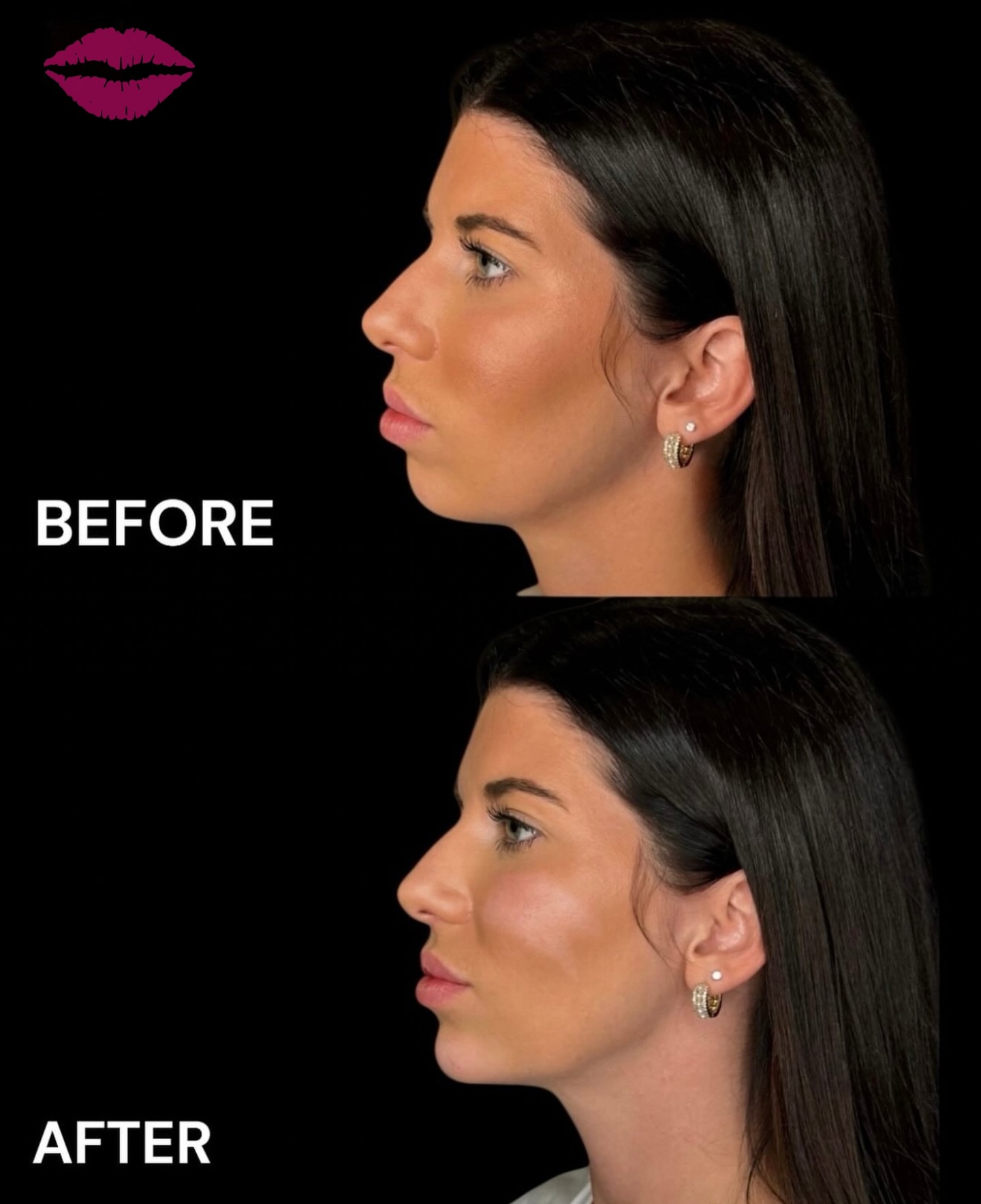 Surgical with a Syringe - Chin definition, perfected 💉❤️
#chinfiller #drduponaesthetics #glowup