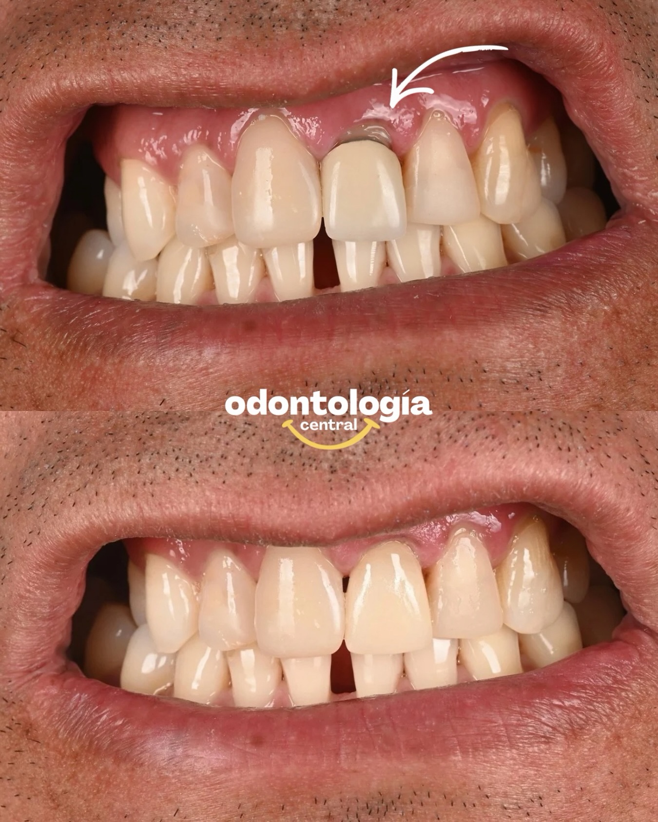 Antes:
Una corona con desajuste marginal y un resultado estético que no armonizaba con la sonrisa del paciente 😞
Después:
Reemplazo por una corona de cerámica realizada con tecnología CEREC, diseñada digitalmente y confeccionada en el mismo día, logrando un ajuste preciso, una estética natural y una integración perfecta con los dientes vecinos 🤩
✨ Odontología de alta precisión, estética avanzada y resultados inmediatos.
Porque cada detalle importa cuando se trata de tu sonrisa 😀
@drvictorvarela
#curanilahue #dentistacuranilahue #clinicadentalcuranilahue #cerec