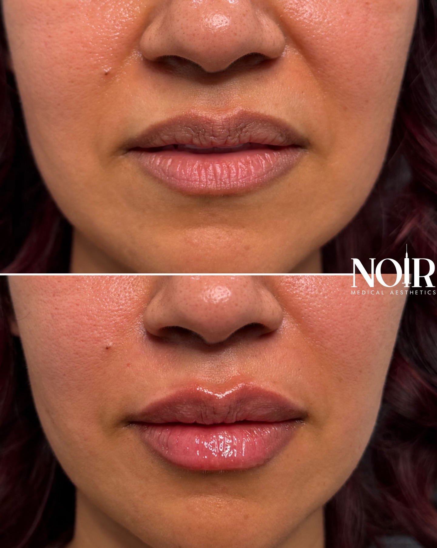 Sometimes you just want a little extra✨
This patient already has naturally full, beautiful lips—her main concern was the fine lines on the lips. We focused on adding subtle hydration and gently enhancing her shape for a smooth, refreshed look. We’re OBSESSED 🖤✨