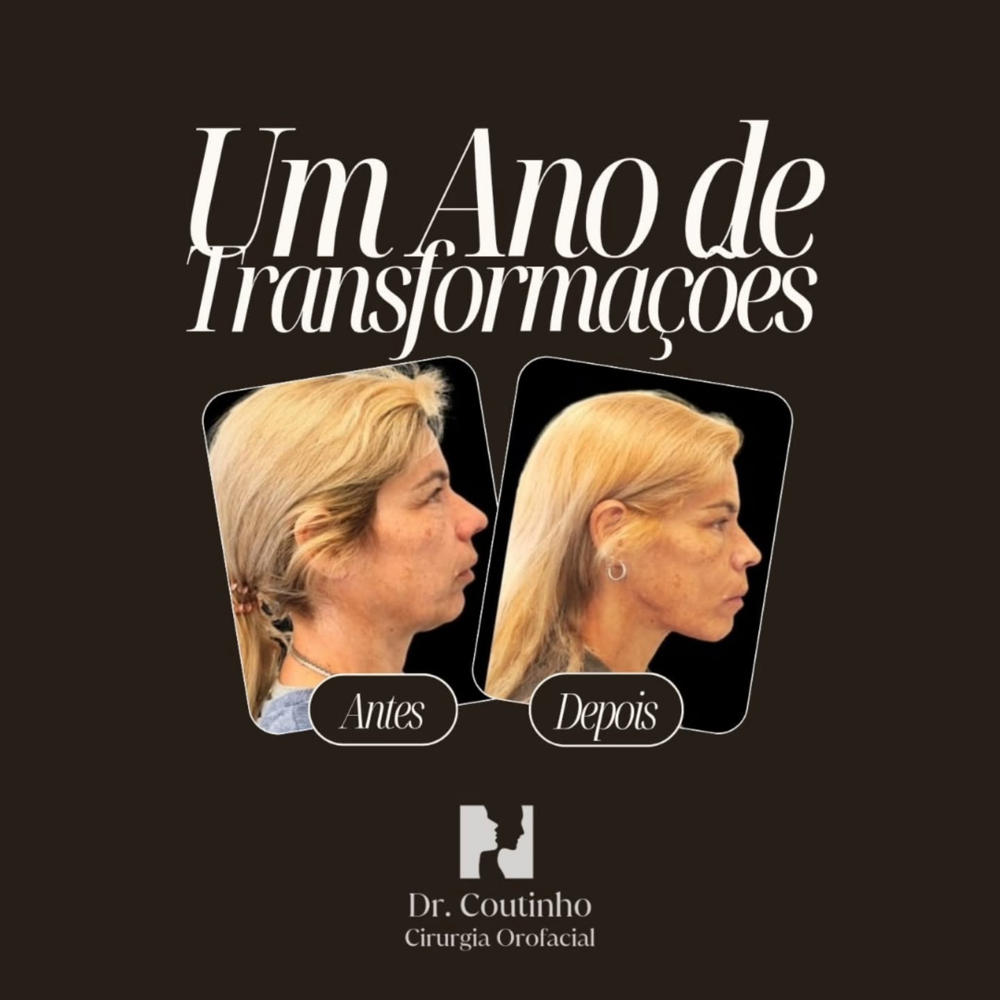 Obrigado 2025. Vamos a isto 2026!
Ao fechar mais um ano, é inevitável parar e refletir.
Foram centenas de cirurgias, muitas horas de dedicação e, acima de tudo, pessoas que confiaram em nós algo profundamente pessoal: o seu rosto e o seu sorriso. Cada transformação vai muito além do que se vê: é voltar a mastigar, a sorrir, a reconhecer-se ao espelho, a ganhar qualidade de vida.
É um privilégio poder exercer uma medicina que transforma de forma tão concreta. Uma honra ser escolhido para esse caminho. E uma responsabilidade que nunca tomamos de ânimo leve.
Partilhamos aqui algumas das transformações que mais nos marcaram em 2025. Seguimos para o próximo ano com o mesmo compromisso: rigor, humanidade e profundo respeito por cada história que nos é confiada.