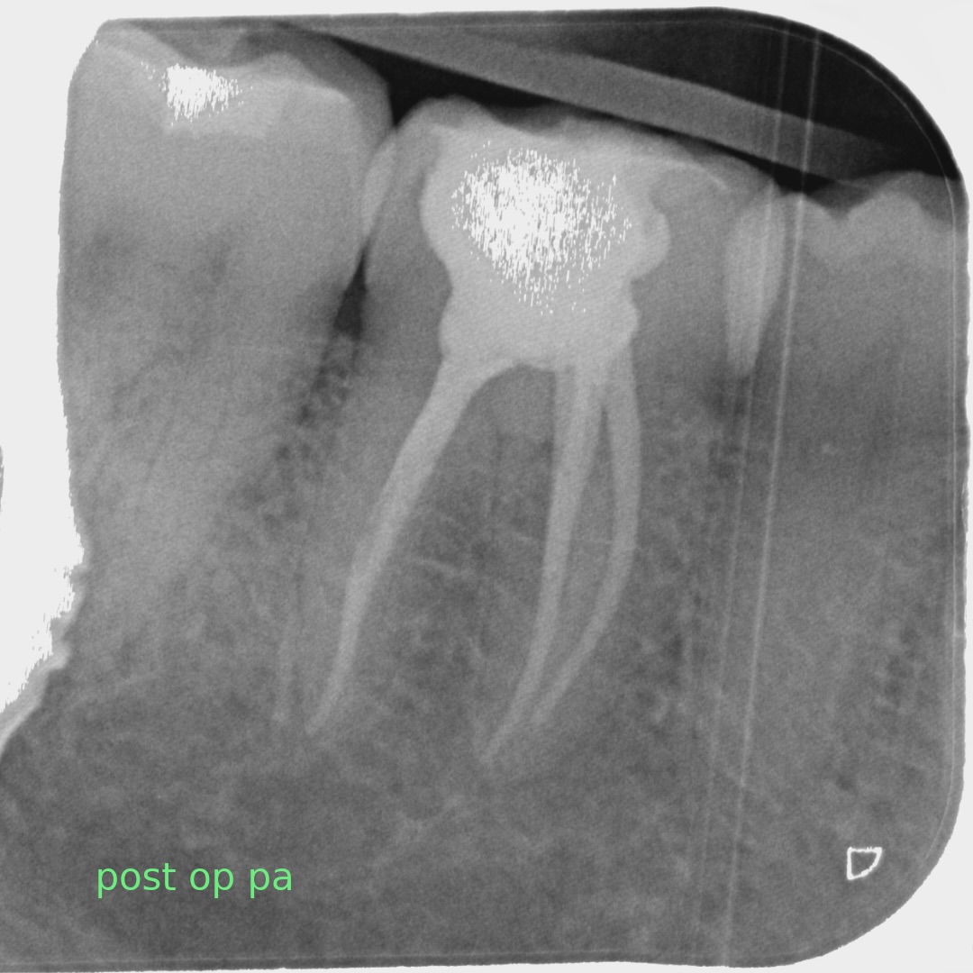 final endo of 2025. 4 orifices with 2 joining mesials on this lr6
#endo #teeth #tooth #rootcanal #dentist
