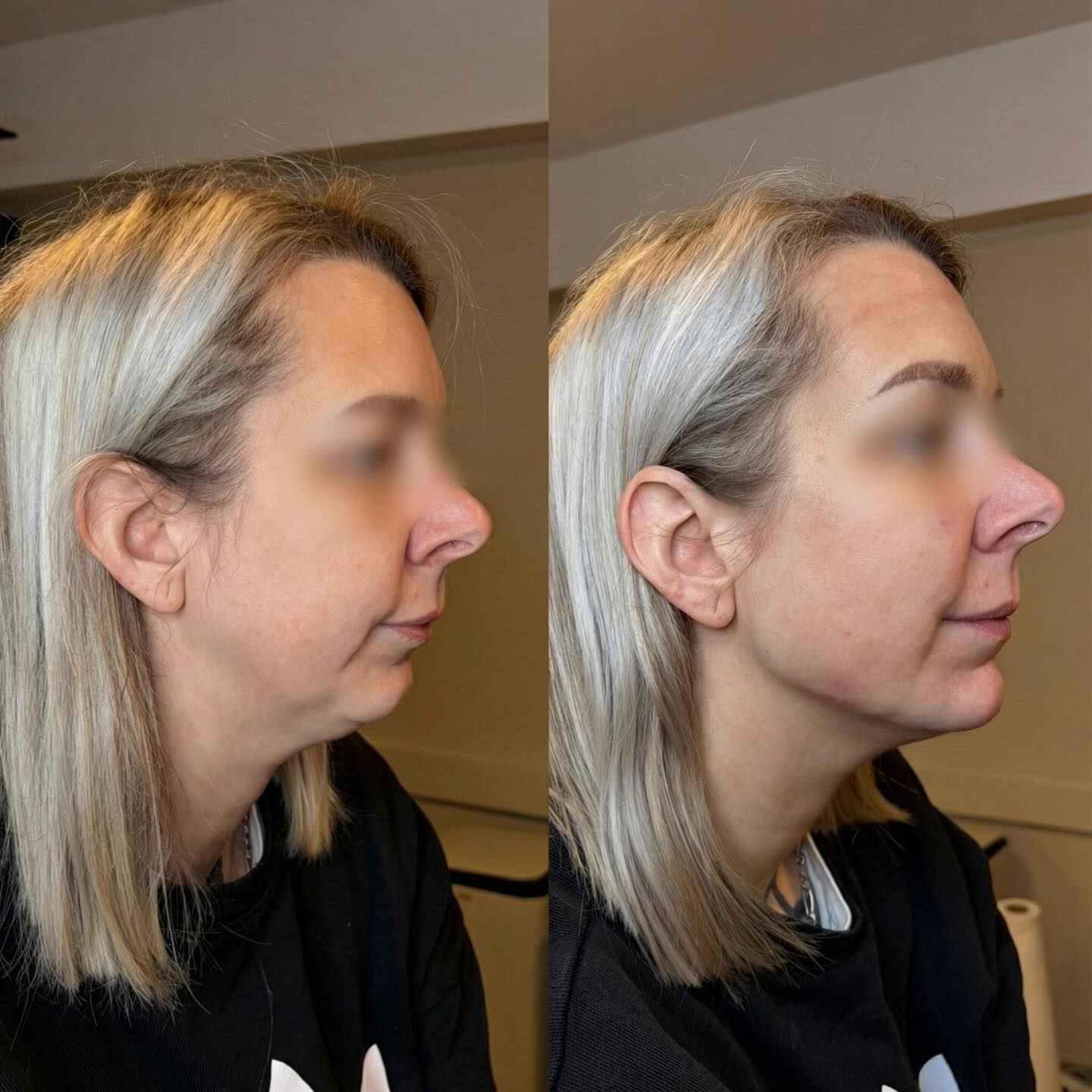 Injection AH Jawline & Menton 5ML ✨