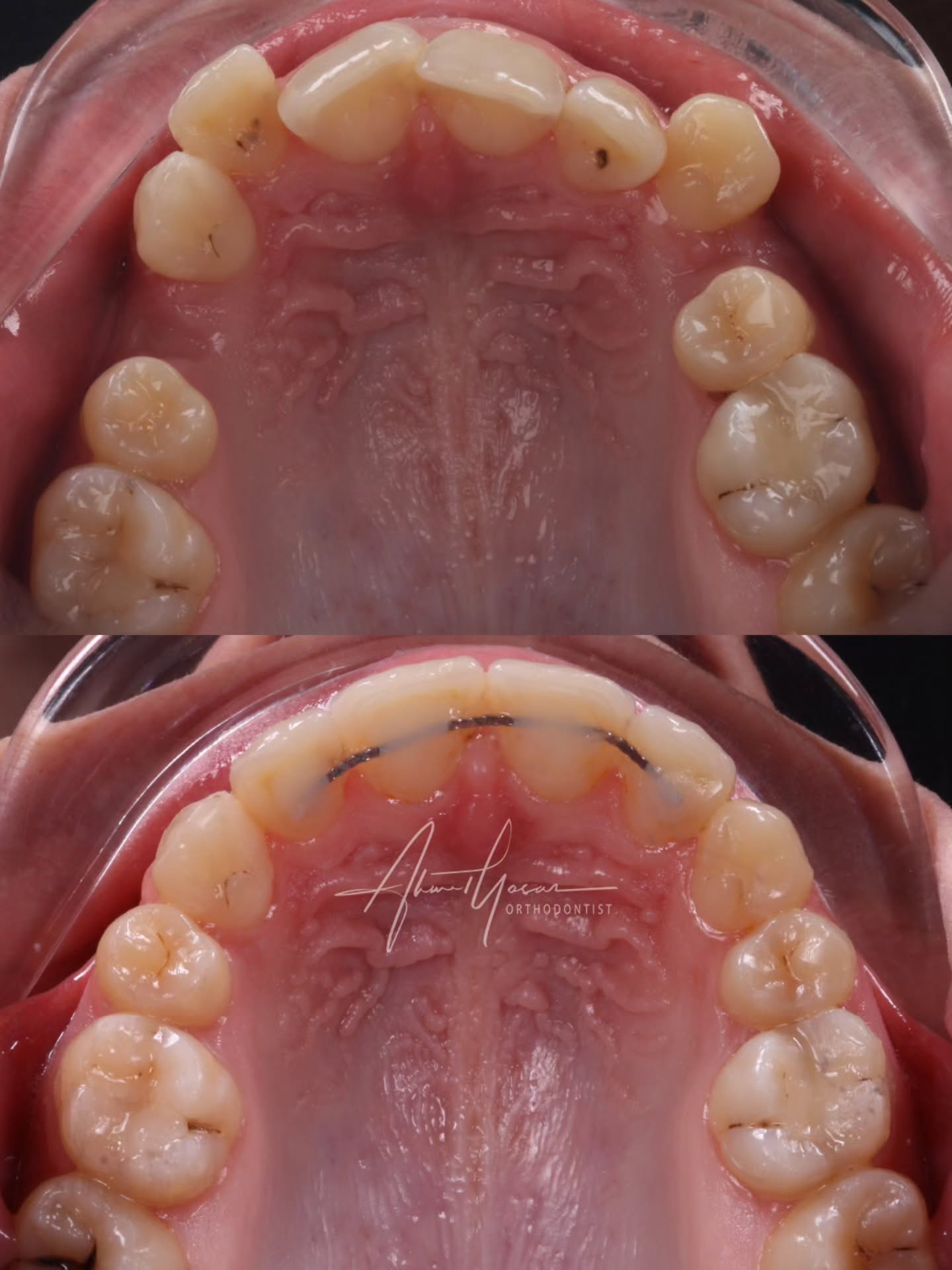 Our clinic is authorized by the Ministry of Health of the Republic of Türkiye for International Health Tourism. All patients have been informed and have provided consent for the use of their photographs on our social media platforms. All content shared on social media is intended to inform patients about procedures and should not be perceived as advertising. Outcomes of any surgical or interventional treatment may vary from person to person. It is recommended to consult your physician for detailed information before undergoing any procedure.
.
.
.
#ortodonti #ortodontist #bursa #bursaortodonti #bursaortodontist