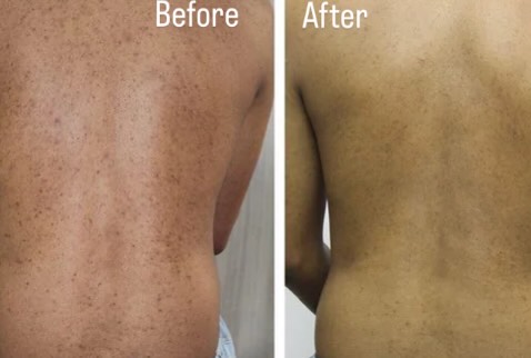 Real results for Keratosis Pilaris ✨
BiorePeel is helping transform rough, bumpy KP-prone skin by deeply exfoliating, stimulating cell turnover, and improving overall texture without excessive downtime. This advanced peel works beneath the surface to unclog follicles, smooth uneven skin, and support healthier skin renewal over time.
With consistent sessions, skin appears noticeably softer, clearer, and more refined, while redness and rough patches are visibly reduced. KP doesn’t improve overnight, but targeted treatments combined with professional care create long-term, visible changes you can feel and see 💙
Smooth skin is possible with the right approach and consistency.
#BiorePeel #KeratosisPilaris #KPSkin #KPResults #SkinTextureImprovement ExfoliationTreatment BodyPeel ProfessionalPeel SmoothSkinJourney SkinRenewal ClinicalSkinCare