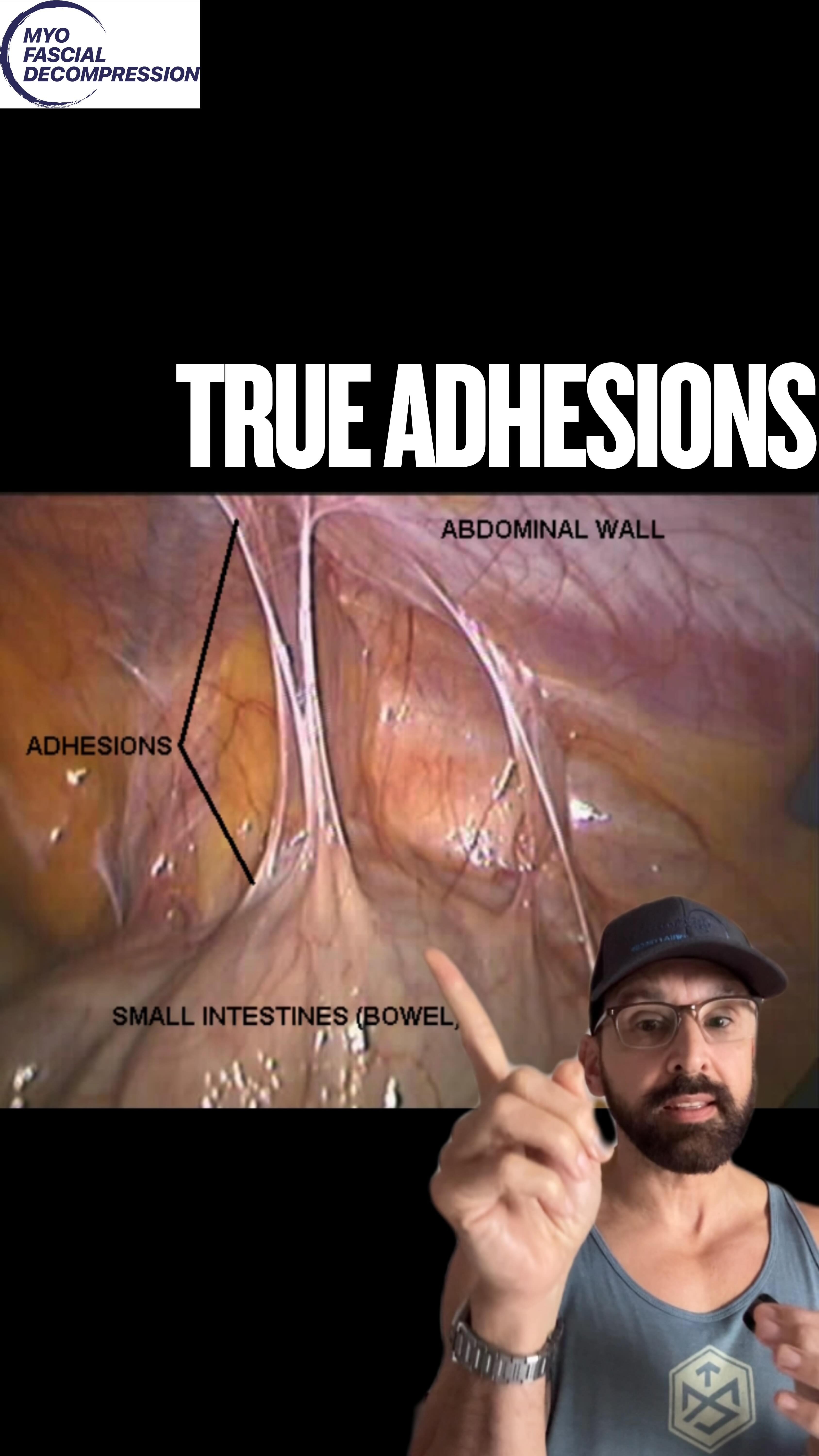 🛑 STOP trying to “break up” adhesions. You can’t.
If your patient has true fibrosis (membrane proteins adherence), your hands or tools aren’t going to tear it apart. You’d need a scalpel for that. 🔪
So, what are we actually doing when tissue feels “stuck” and then suddenly releases?
We are changing viscosity, not structure. 🌊
It’s all about Hyaluronan and Lubricin. These molecules are the body’s natural lubricant that lives between your fascial layers. When you get stiff, they may get sticky (like cold honey).
Manual therapy + movement adds heat and shear force, turning that sticky HA back into a fluid lubricant. We aren’t breaking things; we are hydrating them so they can SLIDE. ⛸️
Watch the end of the video for the visual on why you need glide, not grit.
👇 How do you explain this to your clients/athletes? Drop it below.
#fascia #manualtherapy #mythbusting #adhesions