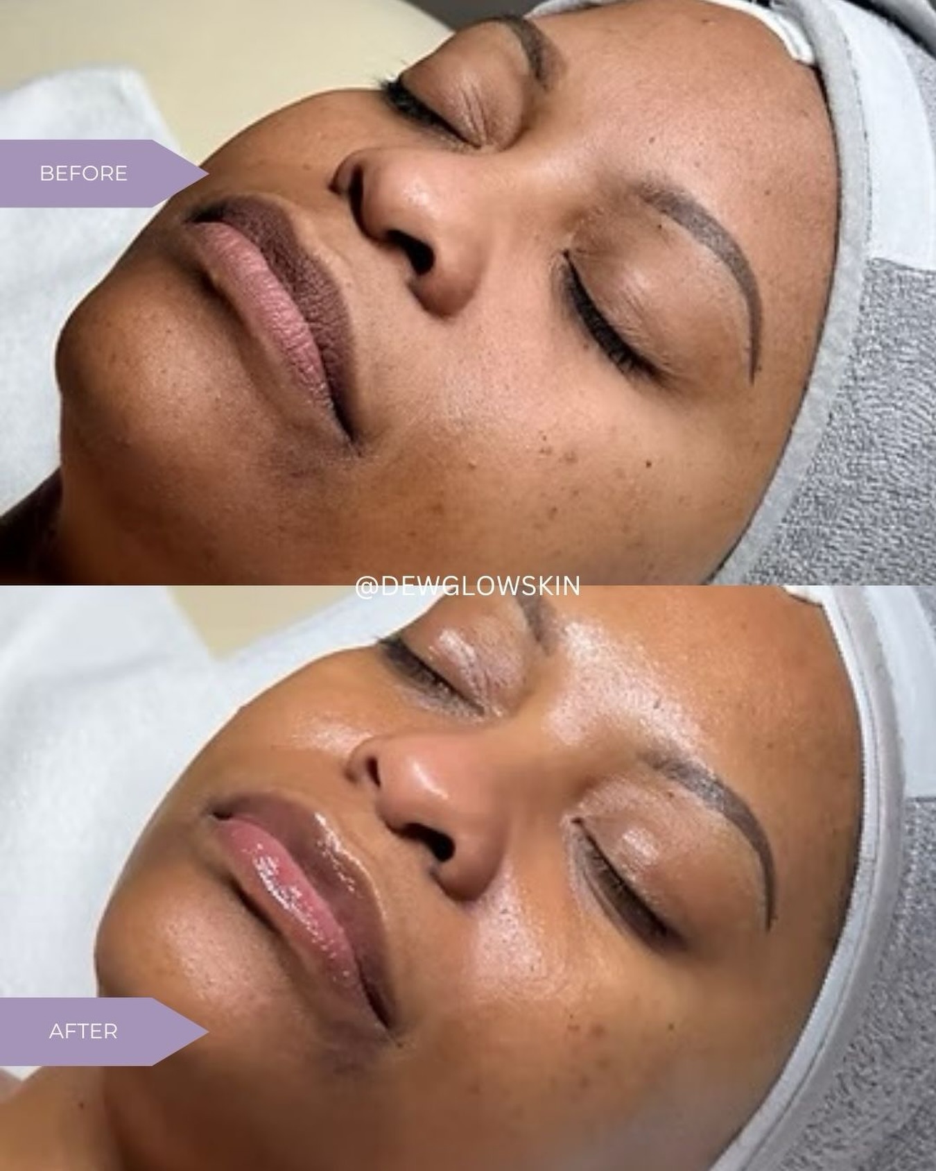 Skin renewal in real time✨
This transformation is the result of our 𝙎𝙞𝙜𝙣𝙖𝙩𝙪𝙧𝙚 𝙂𝙡𝙖𝙨𝙨 𝘿𝙚𝙬 𝙁𝙖𝙘𝙞𝙖𝙡—the hero of our Skin Renewal Series.
Perfect for skin in need of a reset and hydration, this treatment gently resurfaces to smooth texture, refine pores, and restore that fresh glow you can feel and see.
Same skin. Renewed✨
No filters. Just results.
.
.
#snellvilleesthetician #glowwithus #correctivefacials #glassskinfacial #facialbeforeafter