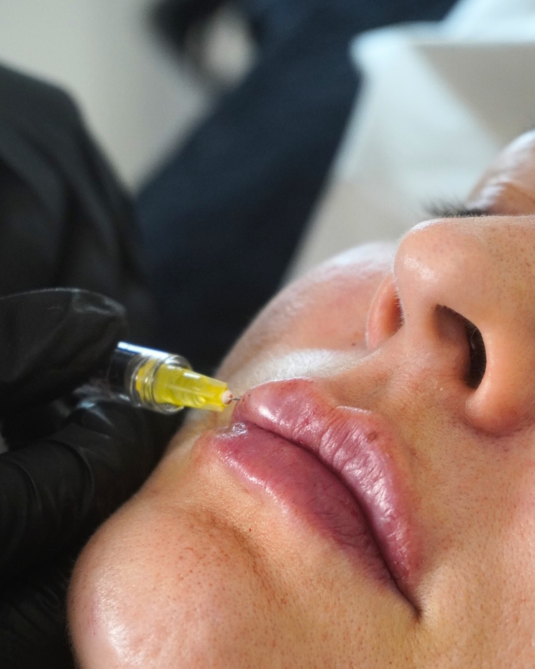 Social media management is often misunderstood as just “posting”
We see it as curating
In the medical aesthetics space, your visual identity is the primary indicator of your clinical precision. If your photos look amateur, the subconscious assumption is that your treatments are too.
We bring the studio to your clinic. No shaky phone footage. No cheap ring lights. Just editorial-grade photography and video that captures the texture, lighting, and detail of your work.
One production day. Three months of pristine assets.
We are now allocating dates for March 2026 content shoots.
#aestheticmedicine #medicalphotography #contentproduction #medspamarketing #clinicbranding