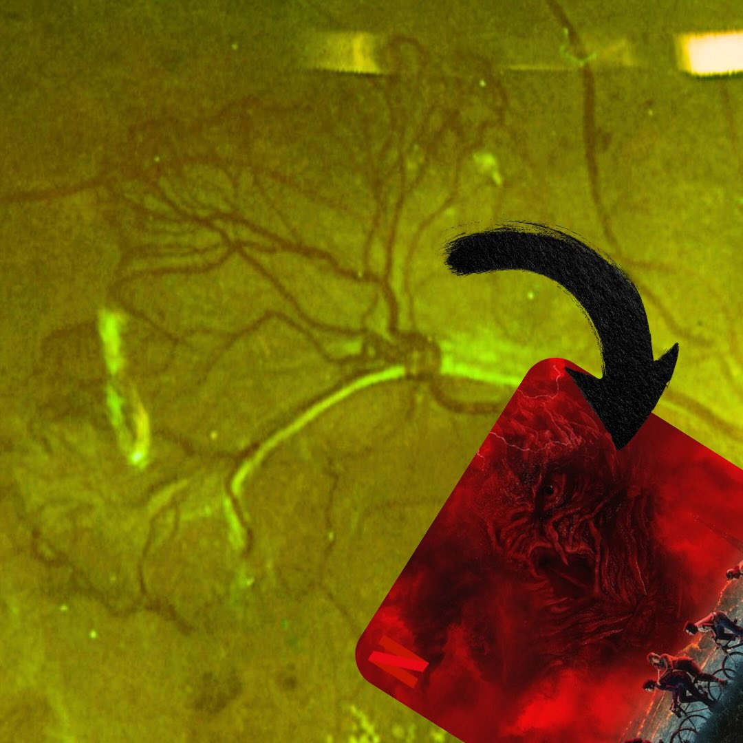 A fundus photo showing neovascularisation from active proliferative diabetic retinopathy. Somehow reminds me of the main villain character (Vecna) in Stranger Things.
#retina #diabeticretinopathy #ophthalmology #strangerthings #eyedoctorchng
