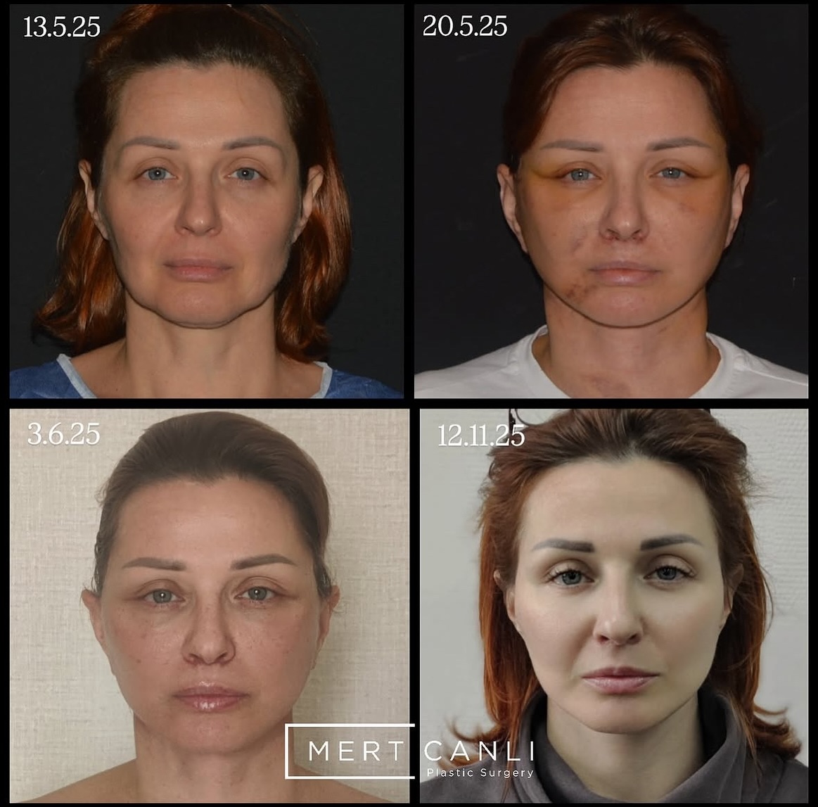 Arcfelvarrás és nyakfelvarrás – 6 hónapos gyógyulási folyamat 👱🏻♀️
Sokan érdeklődnek, hogyan zajlik a felépülés arcfelvarrás és nyakfelvarrás után. Ezért most bemutatjuk az egyik páciensen a gyógyulási folyamatát a műtétet követő első 6 hónapban.
Fontos tudni, hogy minden szervezet másképp reagál, de általánosságban elmondható, hogy
• a duzzanat és a véraláfutások az első 3 hétben jelentősen csökkennek,
• a hegek végleges formája és az eredmény teljes kialakulása viszont 6–12 hónapot vesz igénybe.
A célunk ezzel a bejegyzéssel az, hogy reális képet mutassunk a gyógyulás időigényéről és folyamatáról.
#deepplane #deepplanefacelift #deepplanenecklift #arcplasztika #arcfelvarrás #plasztika #plasztikaimutet #esteworld