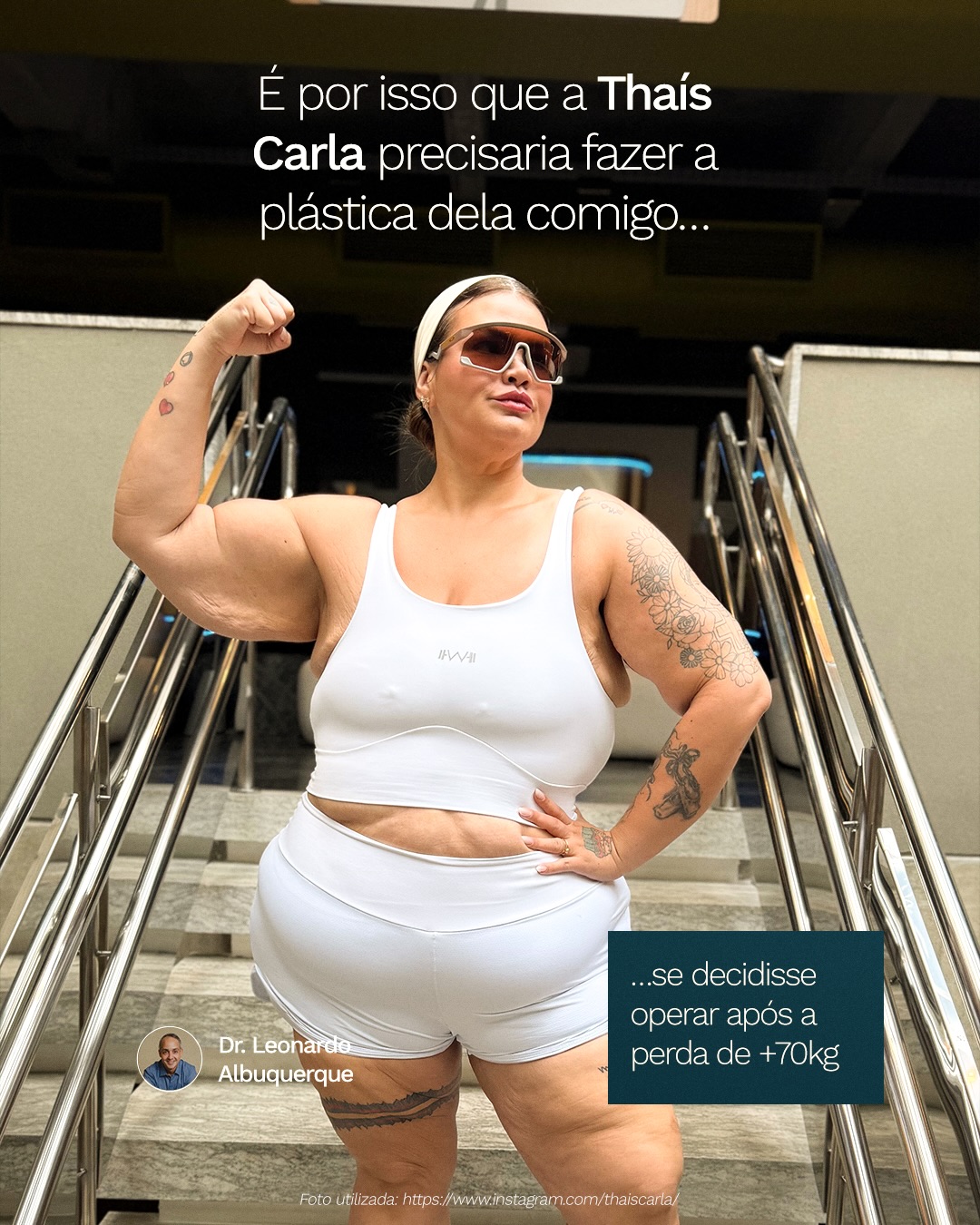 Grandes perdas de peso deixam marcas que não aparecem nas fotos: ✅ mudanças na pele,
✅ no suporte dos tecidos,
✅ na forma como o corpo cicatriza.
É por isso que o pós-emagrecimento exige um planejamento muito mais técnico, individual e seguro.
Na consulta, avalio cada detalhe da sua anatomia para definir o que realmente é possível — e o que vai trazer um resultado natural e duradouro.
📲 Clique no link da bio e descubra seu corpo ideal.
Dr Leonardo Albuquerque | Cirurgia Plástica
Formado pela USP e membro da SBCP
CRMBA 23068 | RQE 10486
📍Ilhéus - Bahia
.
.
.
#ThaisCarla #bariatrica #DrLeonardoAlbuquerque