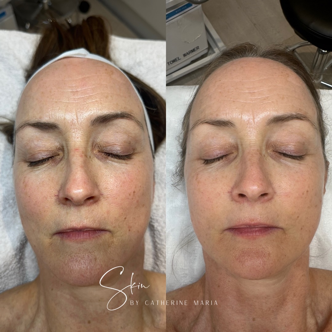 One of my absolute favourite things about my job is watching your confidence grow alongside skin health.
It’s a pleasure working with Suz and supporting her skin journey has been incredibly rewarding. This before and after photo was taken during a course of 3 DECAAR treatments, supported with Dermalux LED to calm inflammation, boost healing and enhance results.
She’s now using a tailored AlumierMD skincare routine, which has helped maintain hydration, support collagen and keep her skin looking brighter, smoother and healthier overall - she’s glowing in the gym!
Super proud of her commitment and trust in the process 🤍
If you’d like support, feel free to message me or book in when you’re ready.
🗓️ Book via the link in bio
📍 Aylesbury, Buckinghamshire
📩 info@skinbycatherinemaria.com
🌍 www.skinbycatherinemaria.com
#aylesbury #aylesburybusiness #aylesburyvale #aylesburybeauty #aylesburyfacial