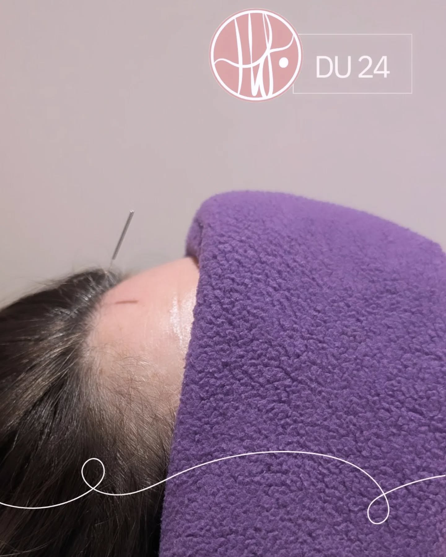 🌿 DU 24 - Courtyard of the Mind 🌿
Especially powerful at calming the mind and regulating emotions.
Eases Anxiety.
Helps improve Sleep.
Eases Restlessness, overthinking and a racing mind.
Soooo useful when treating stress driven hormonal disruption, Luteal phase problems, PMS, history of loss, supporting through Assisted fertility.
#acupuncture
#fertilitysupport
#TCM
#stressreduction
#nervoussystemreset