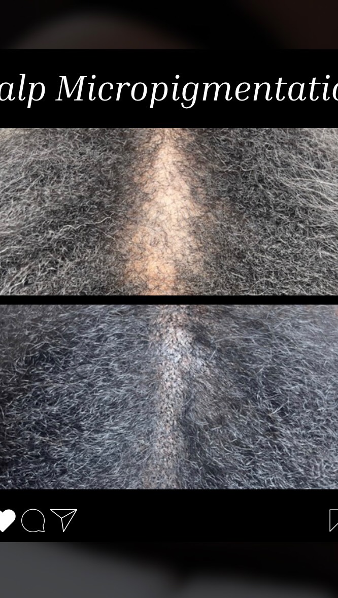 Scalp Micropigmentation can definitely restore confidence for those with alopecia, hair loss, thinning and baldness. This is the hair transplant alternative and affordable way to add density for fuller hair.
Two to three sessions are needed for optimal and lasting results. Contact us to inquire or book a confidential consultation with our SMP Artist.
BEATANDBLADE.COM
#alopecia #hairloss #beforeandafter #transformation