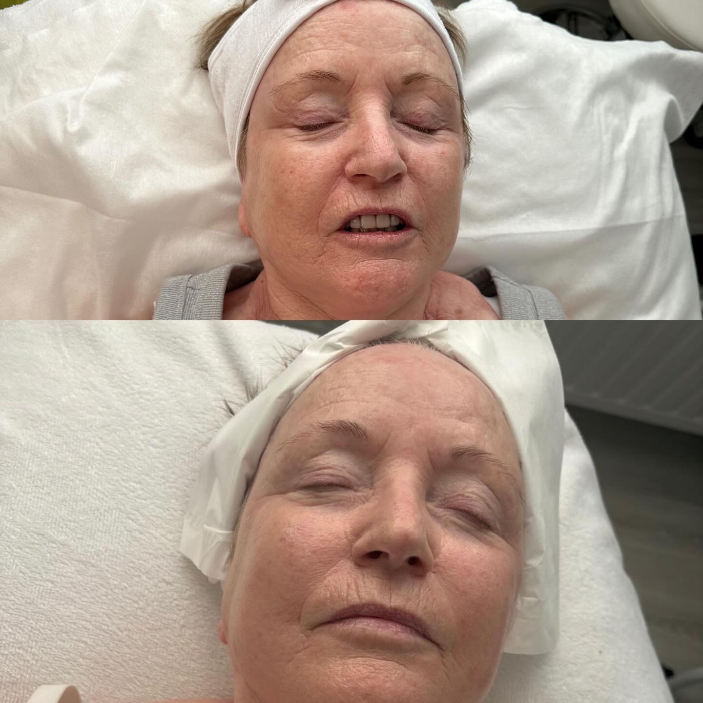 Remember Maxine’s results after just one session? ✨
Yesterday she completed her full course of 6 collagen lift sessions and… wow 🤍
Firmer skin, improved texture and a natural, healthy glow.
This is what consistency and collagen stimulation can do 👌