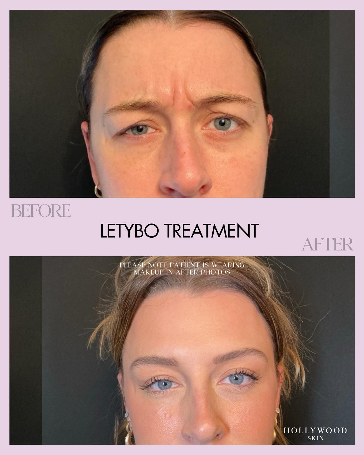 The kind of results we aim for with Letybo: softened lines, smoother movement, and a more relaxed expression without looking frozen or overdone.
In this treatment, we focused on:
The glabella (11s) to soften the deep frown lines between the brows
Forehead lines to smooth while still allowing natural expression
Crow’s feet to relax the eye area without weighing it down
Please note: the patient is wearing makeup in the after photos, which can enhance brightness and skin tone.
2026 is off to a smooth start for this beauty!
HWSkin.com
#HollywoodSkin #HollywoodSkinBeforeAndAfter #LetyboNeurotoxinParkRidge #ParkRidgeInjector