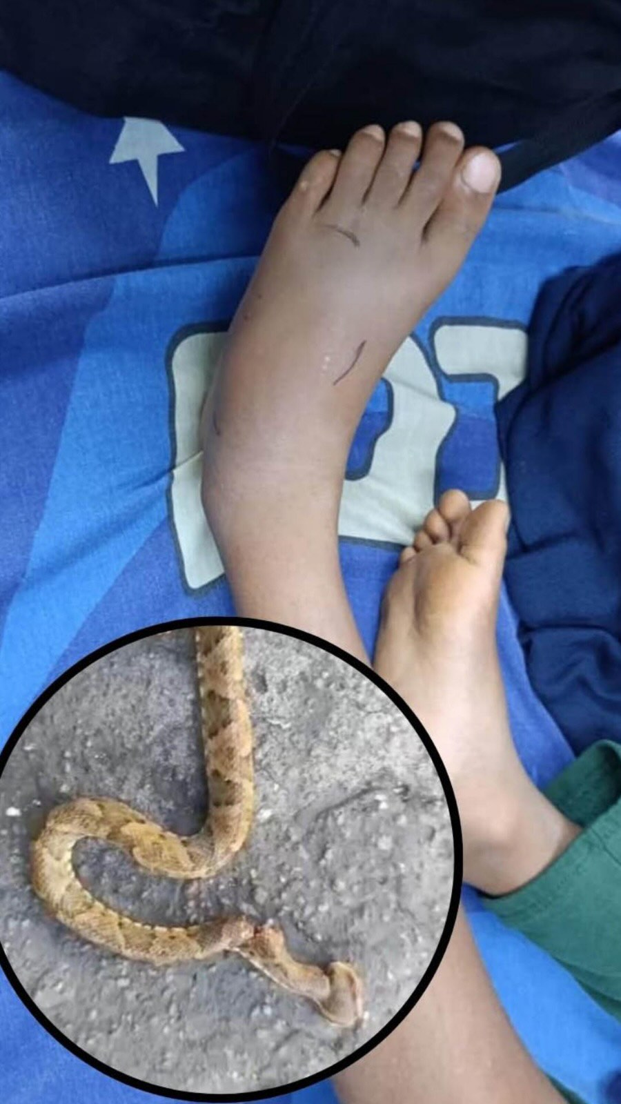 Hoy apoyamos nuestro primer caso del 2026.
Un niño de 12 años, proveniente de Tejerías, fue mordido por una serpiente venenosa y se encuentra hospitalizado en La Victoria, estado Aragua.
La evolución clínica requiere exámenes de laboratorio y seguimiento médico continuo.
La familia es de bajos recursos y necesita apoyo para cubrir estos gastos.
Cualquier ayuda suma.
Cualquier aporte cuenta.
📌 Si deseas colaborar:
Bancamiga, Pago Movil:
J-502156399 / 0424-408.5311
Cta. Corriente:
0172-0201-49-2015105170
Fundación Vivarium — preservando vidas.#fundacionvivarium #preservandovidas #snake #venezuela #envenenamientoofidico
